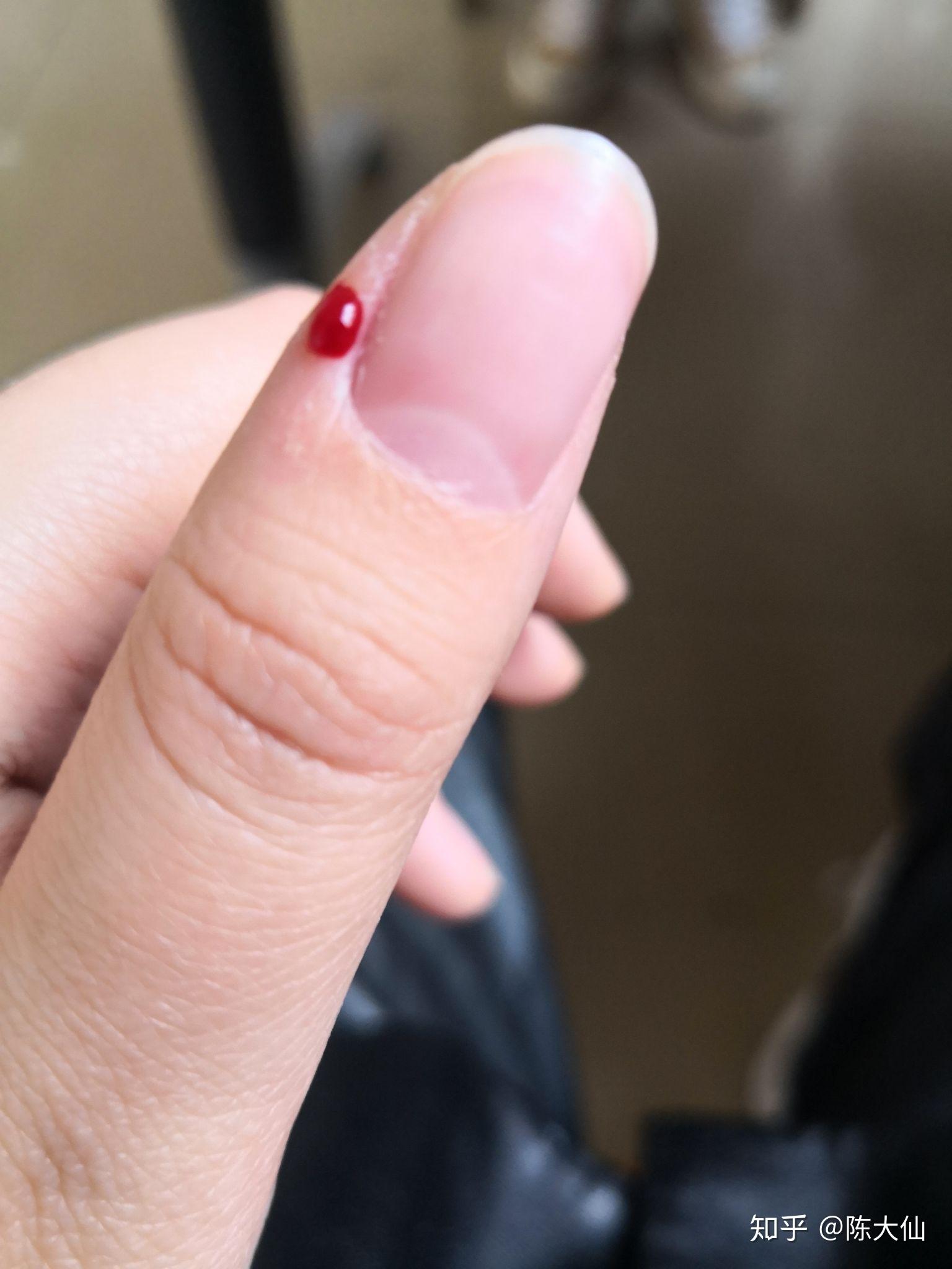 克制不住的抠手指头是心理问题吗