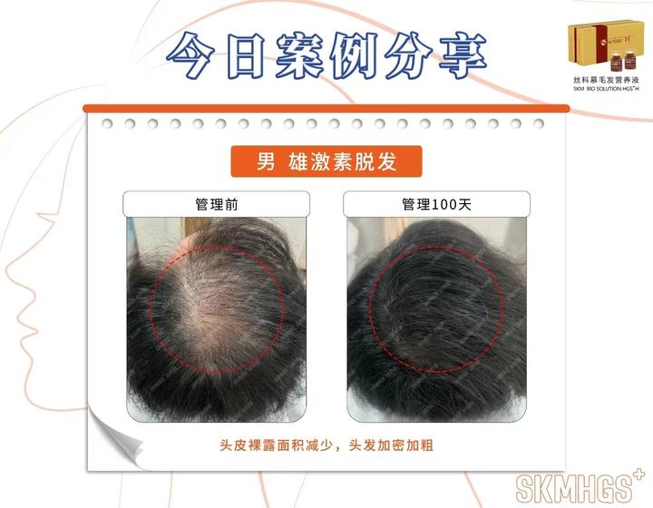 发旋处头发变得稀少可以恢复吗 - 知乎