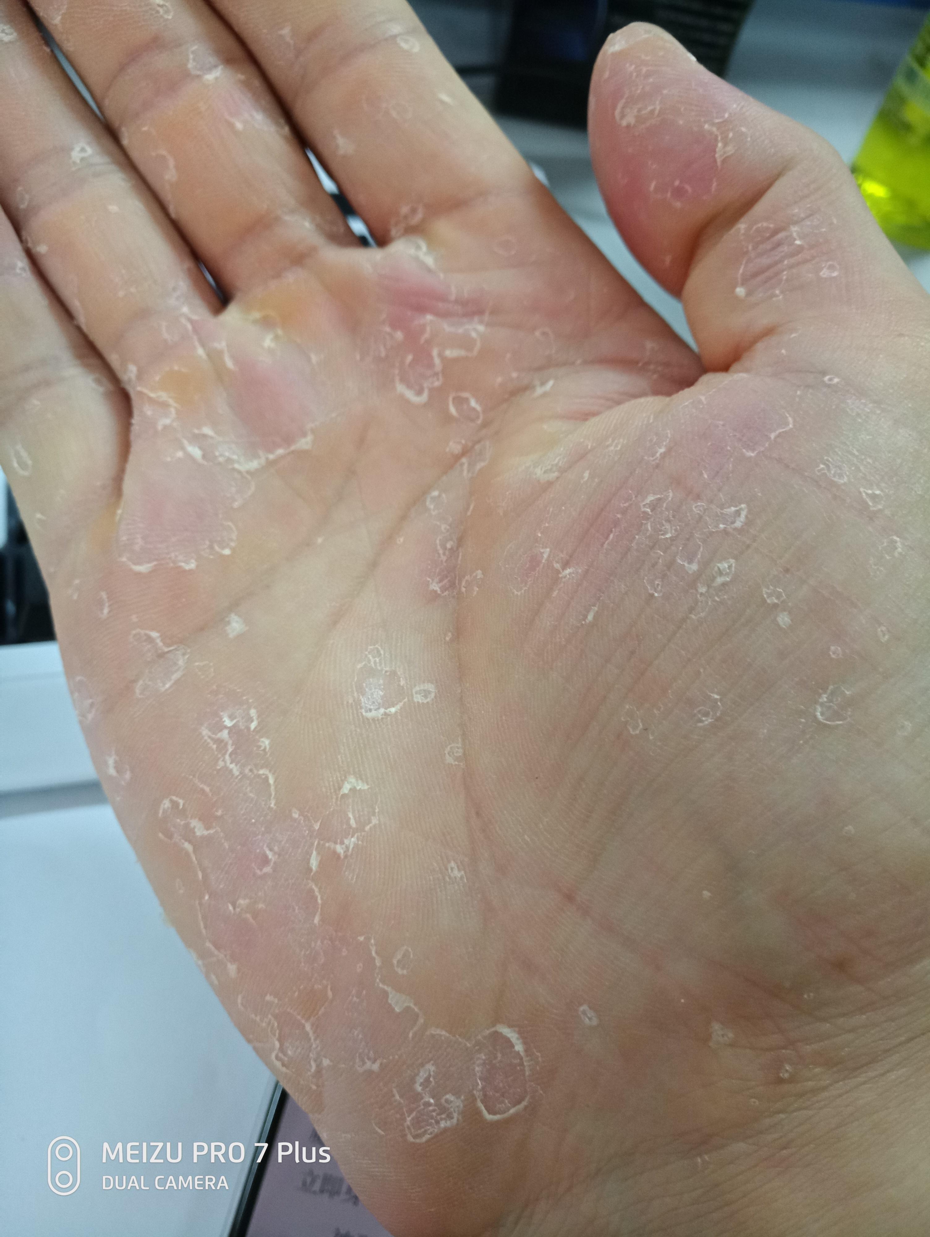 季节性手脱皮什么原因有什么方法可以根治吗
