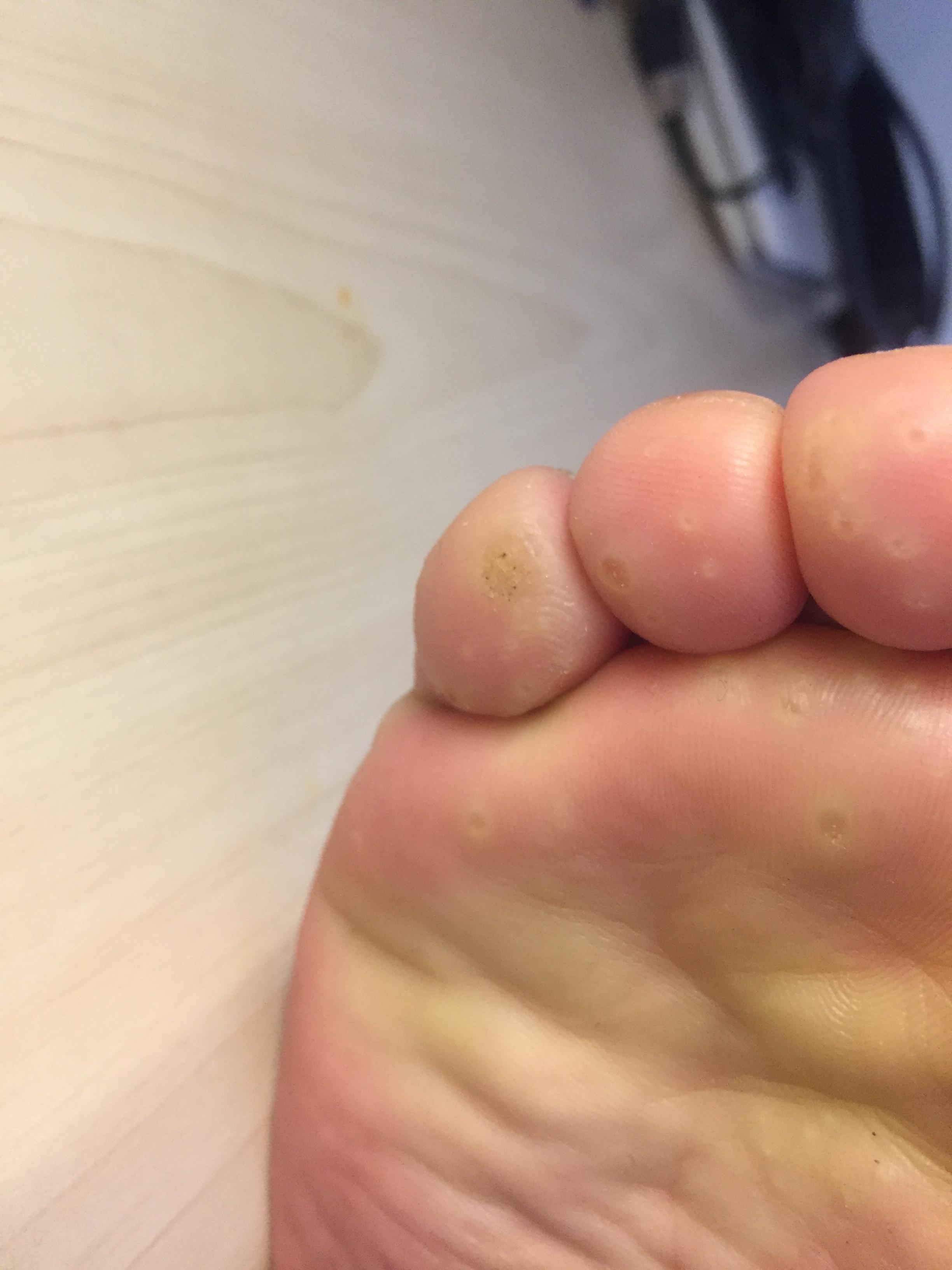 我脚上长了跖疣怎么办,很多医院都没有确切治疗办法? - 知乎