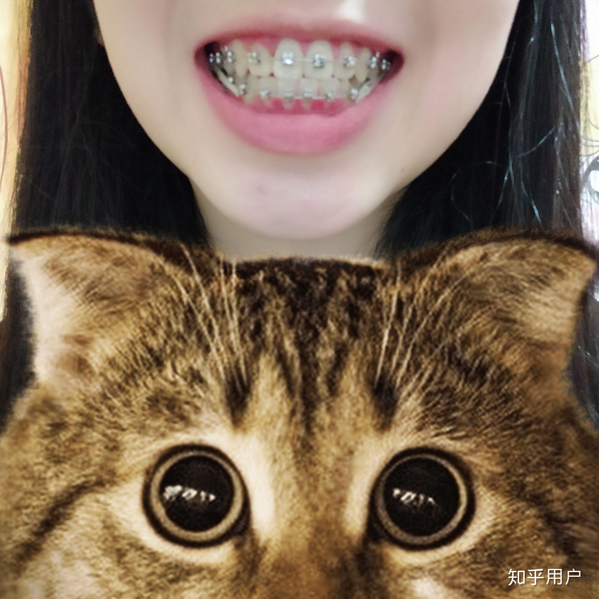 来说说牙齿矫正挂小皮筋是什么感受?