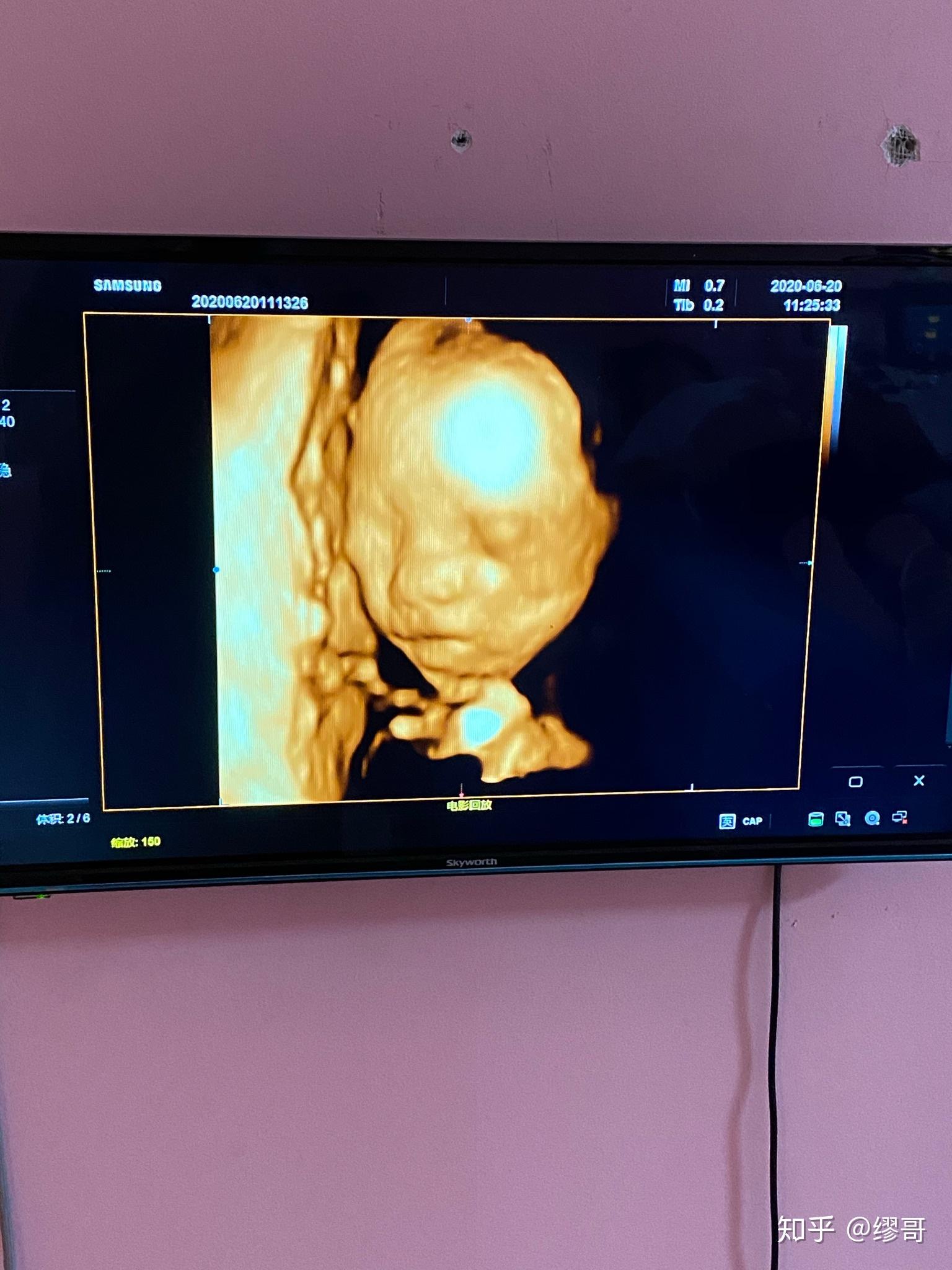怀孕20周四维彩超图图片