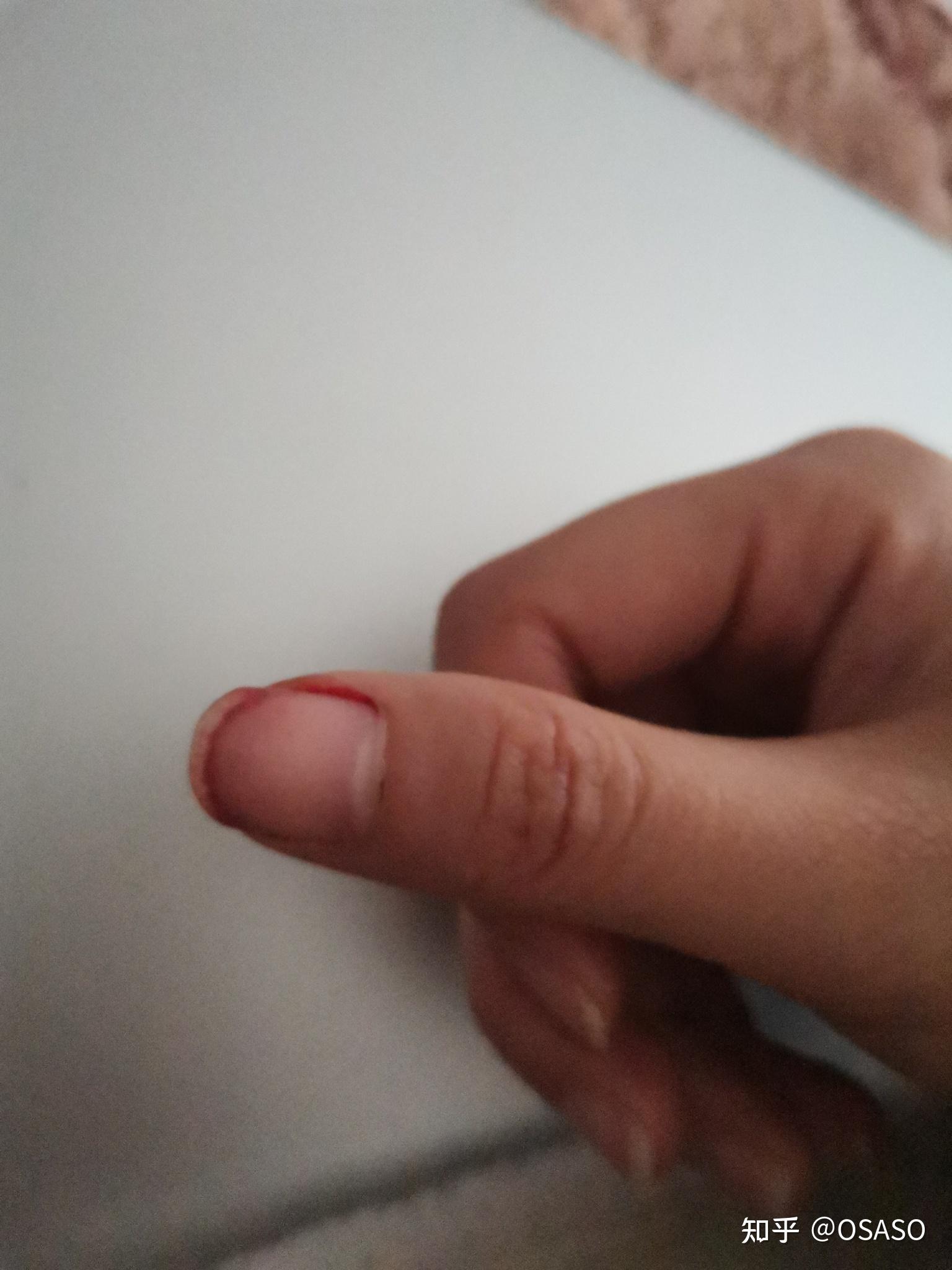 关注问题 67 写回答 登录/注册 健康 指甲 出血 指甲为什么莫名