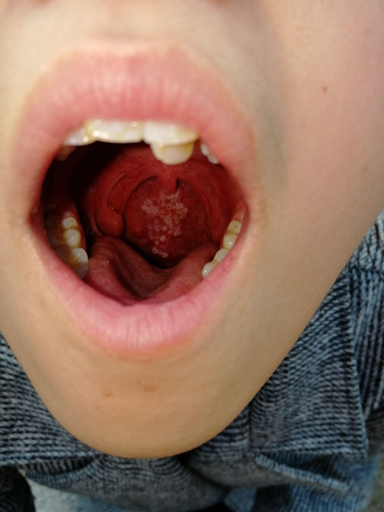 慢性咽喉炎图片喉癌图片