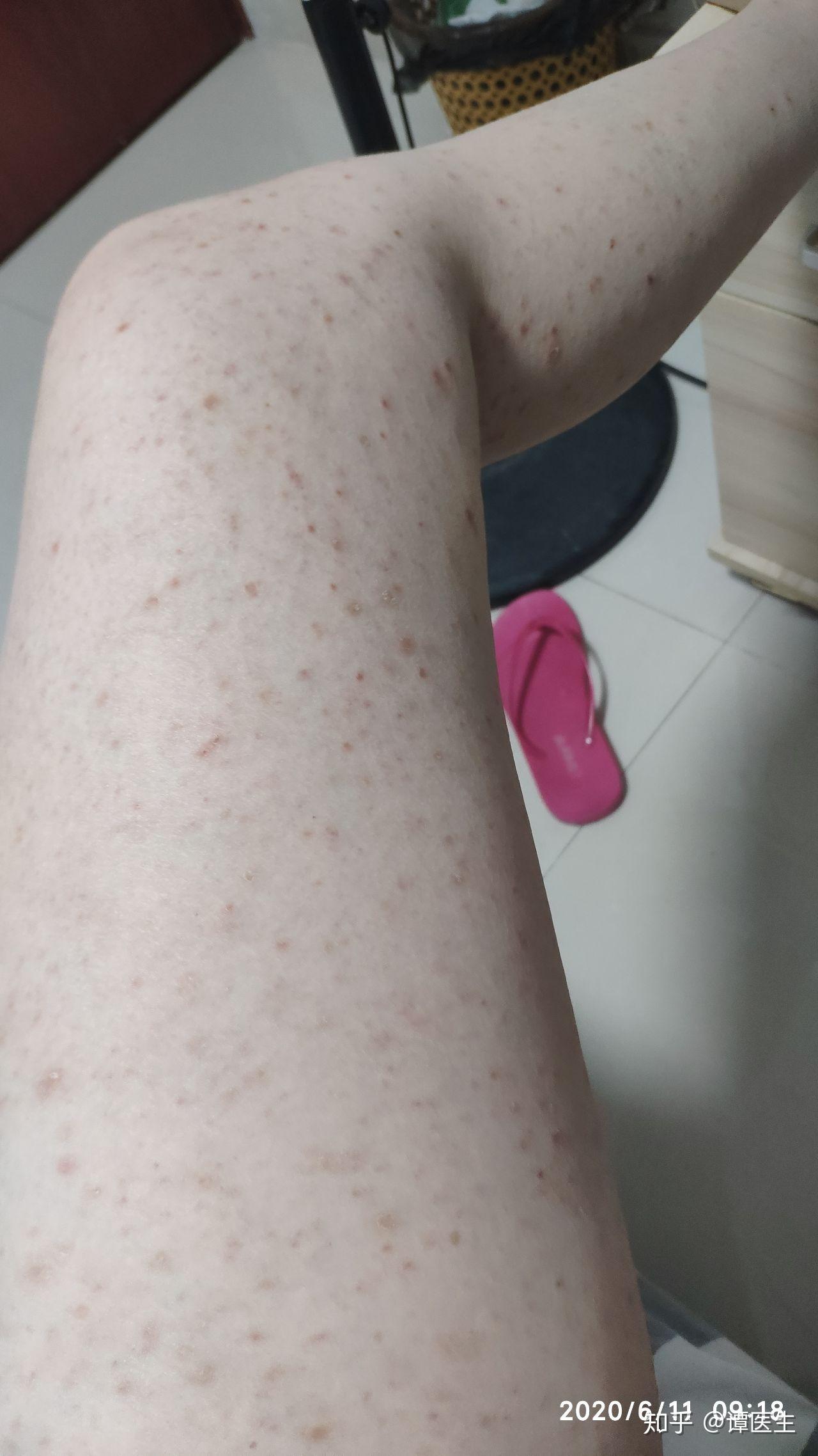 为什么有时候吃虾会过敏有时候不会