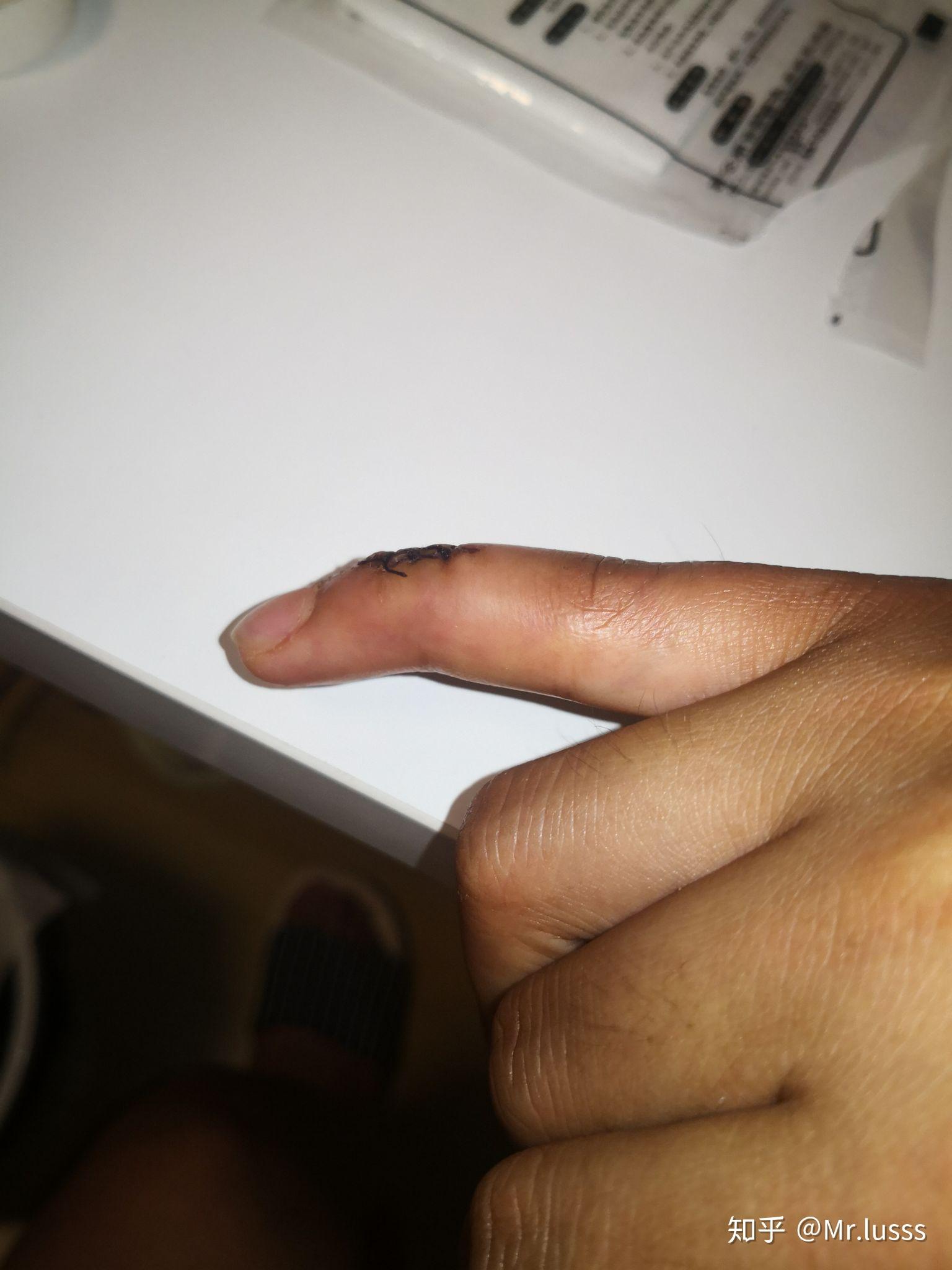 打篮球时手指戳伤不能伸直,求有经验的大神告诉我这是否严重啊!