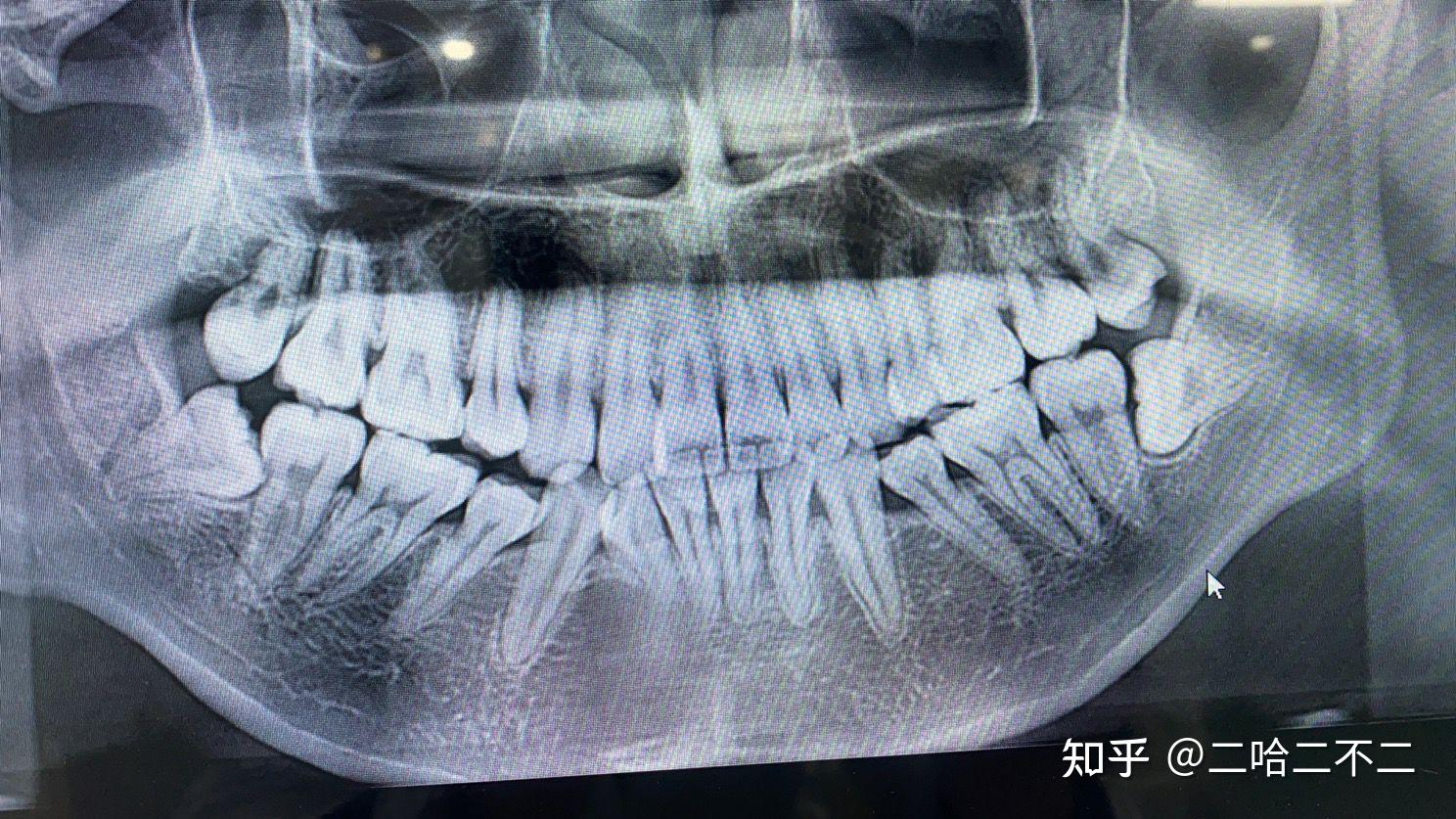 拔横着长的智齿是怎样的体验