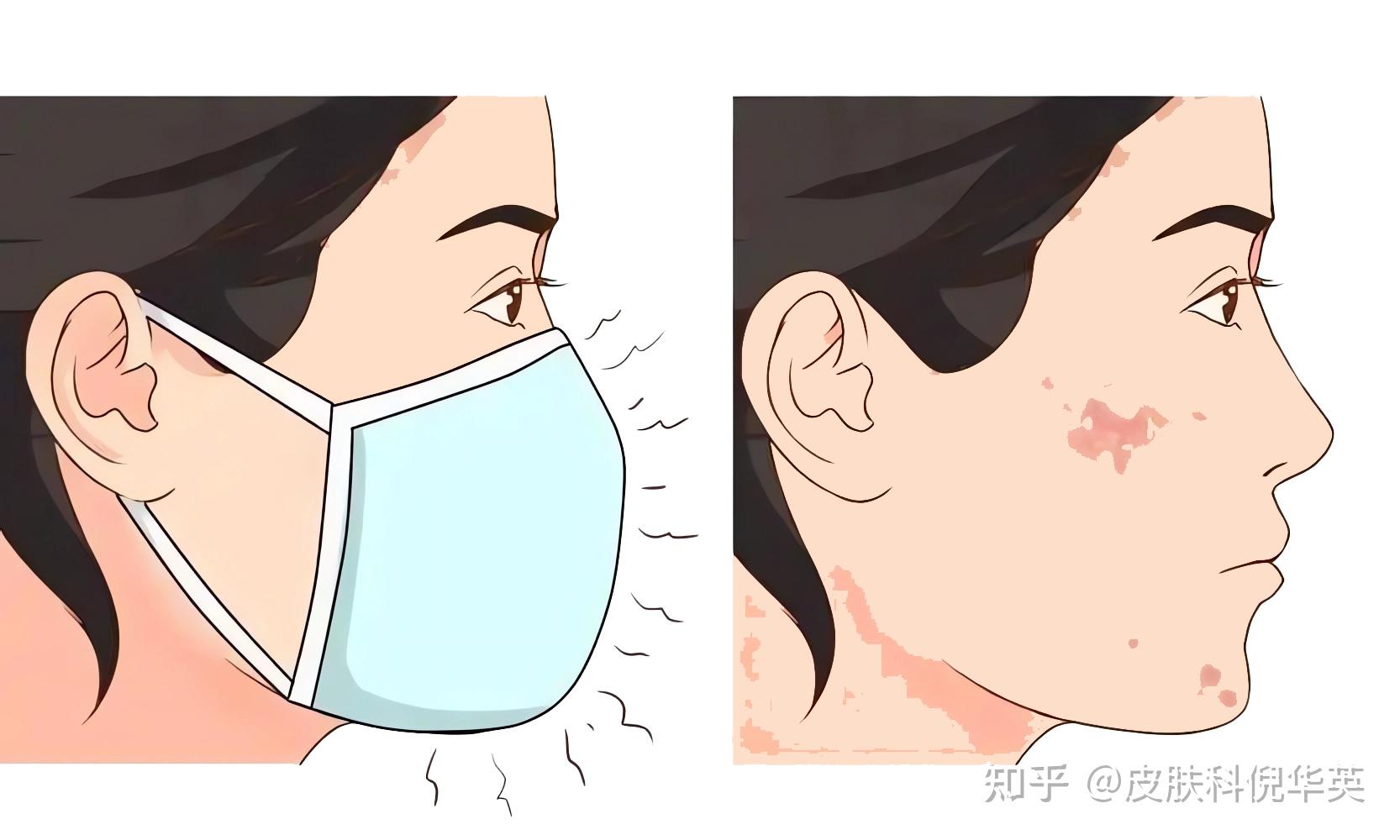 “面部皮炎”知多少 - 知乎