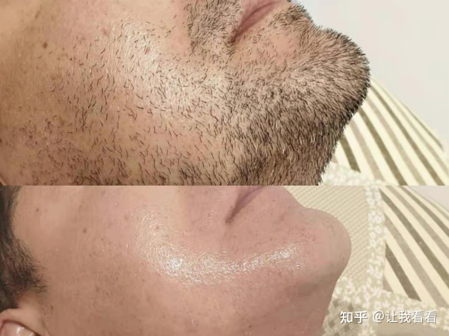 老铁们激光脱毛络腮胡会有效么