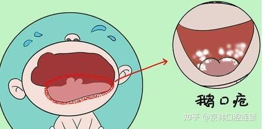 宝宝口腔奶瓣擦不掉？可能是长鹅口疮了 - 知乎