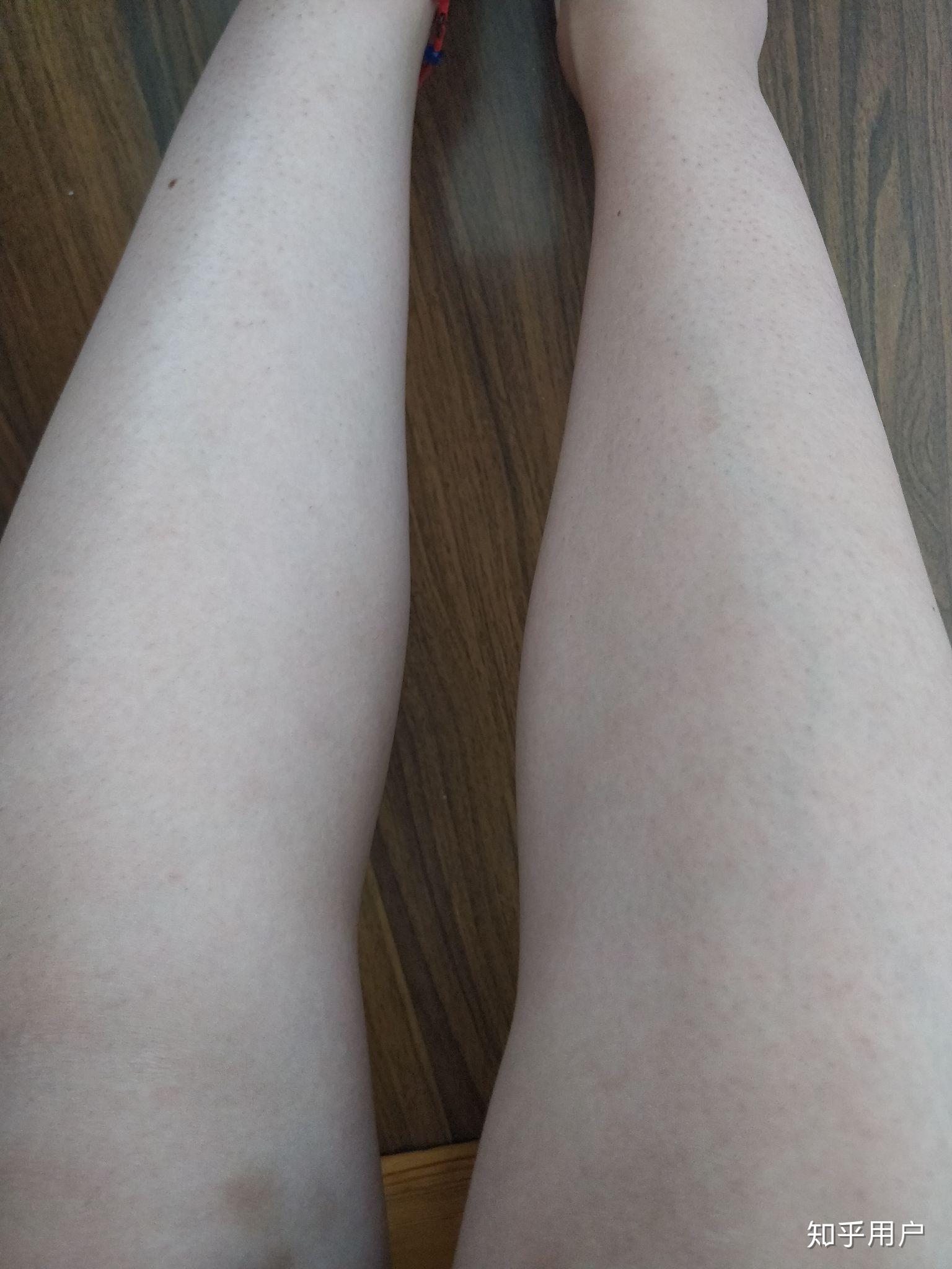 腿毛多的女生怎么处理