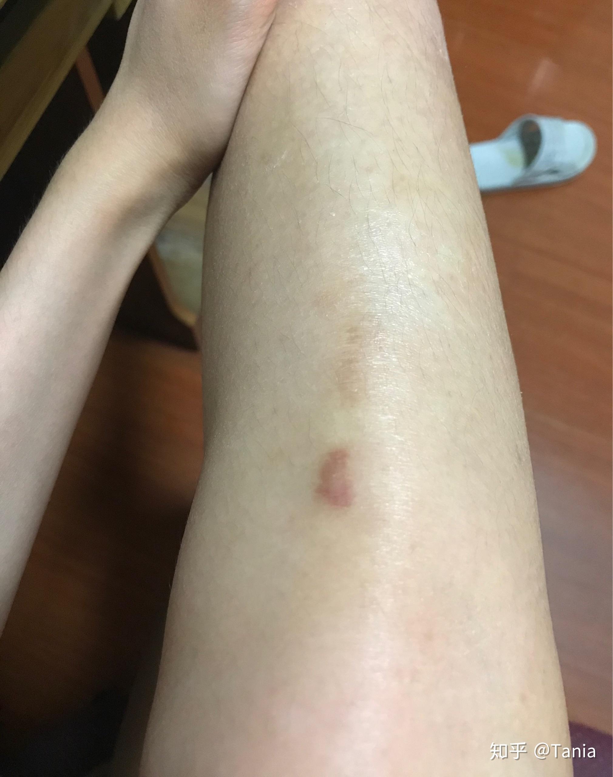 你们会嘲笑一个腿上有疤痕的女生吗? - 知乎