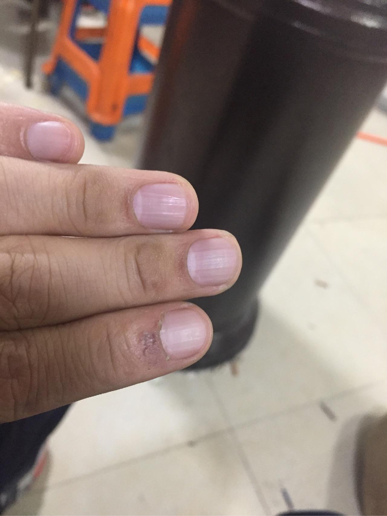 指甲有竖纹究竟是什么原因?总体颜色有点偏紫色,怎么回事? 