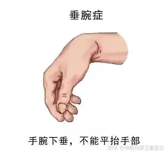 一文读懂:手部神经损伤与各类掌形类型表现 - 知乎