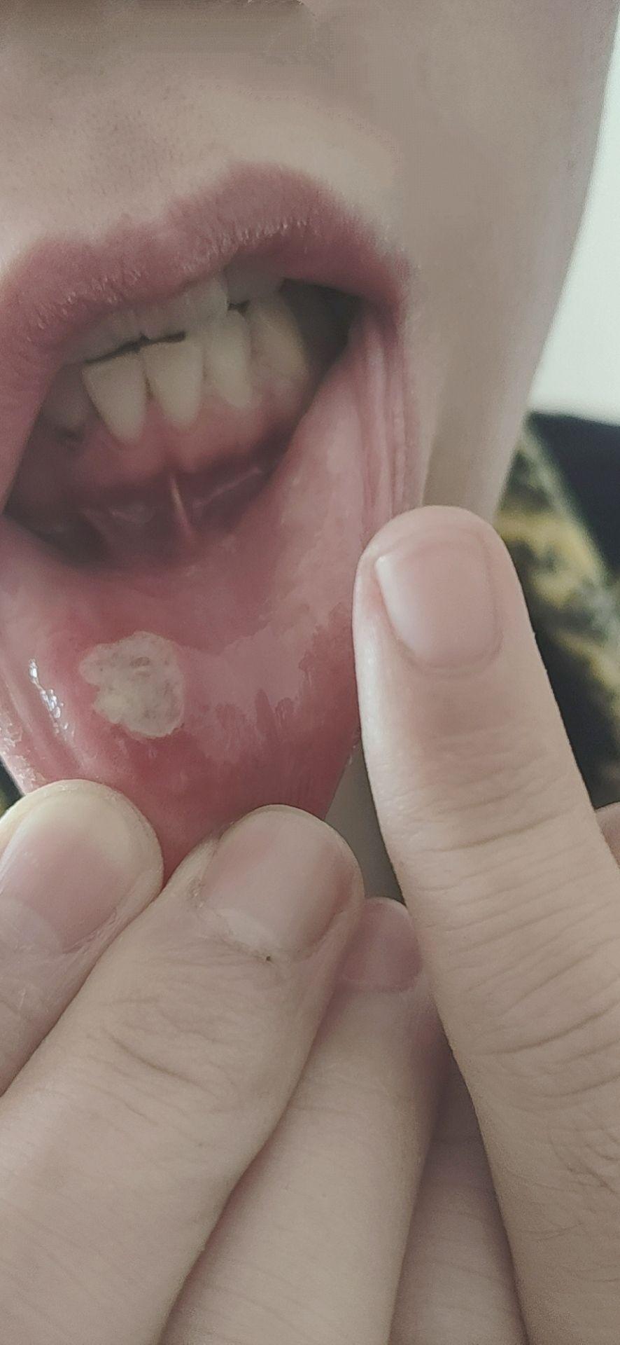 口腔溃疡留下的疤痕图图片