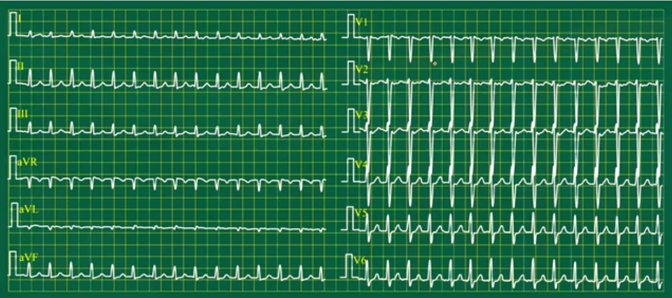 心电图简论-心电图读图方法：在执业医师实践技能考试范围内的心电图 - 知乎