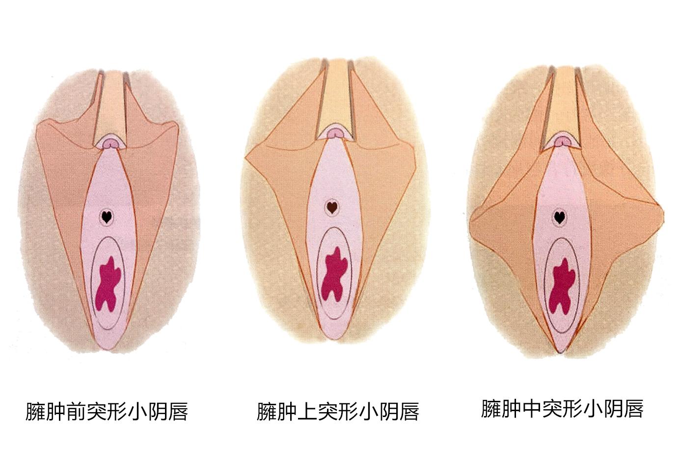 小阴唇 小阴唇全解】（八）你的小阴唇肥大属于哪一种形态？—5种形态分析- 知乎
