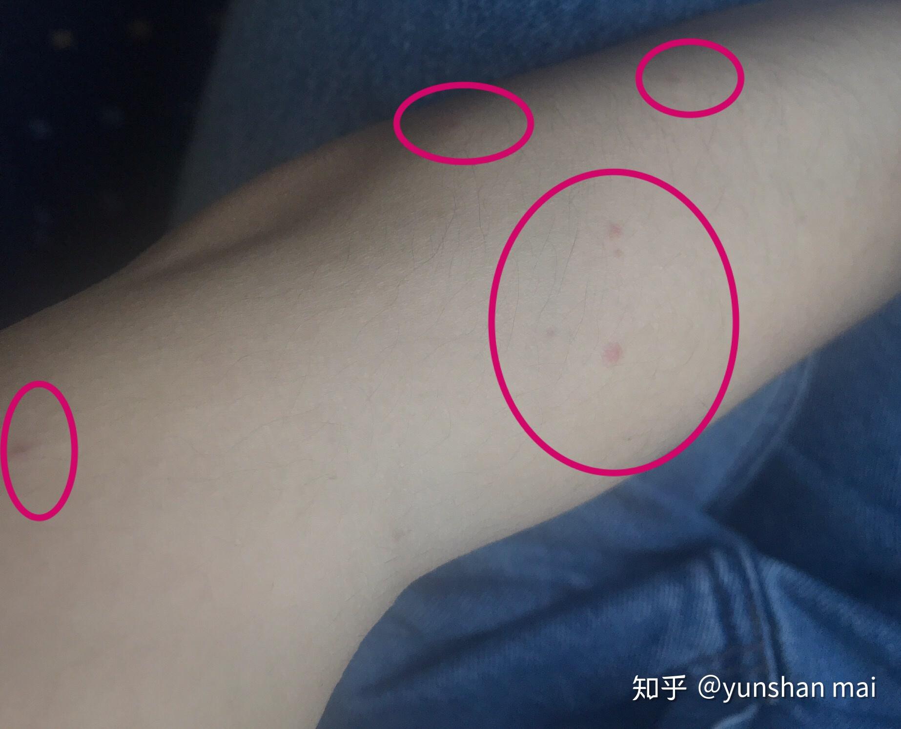 螨虫严重过敏是种怎样的体验?