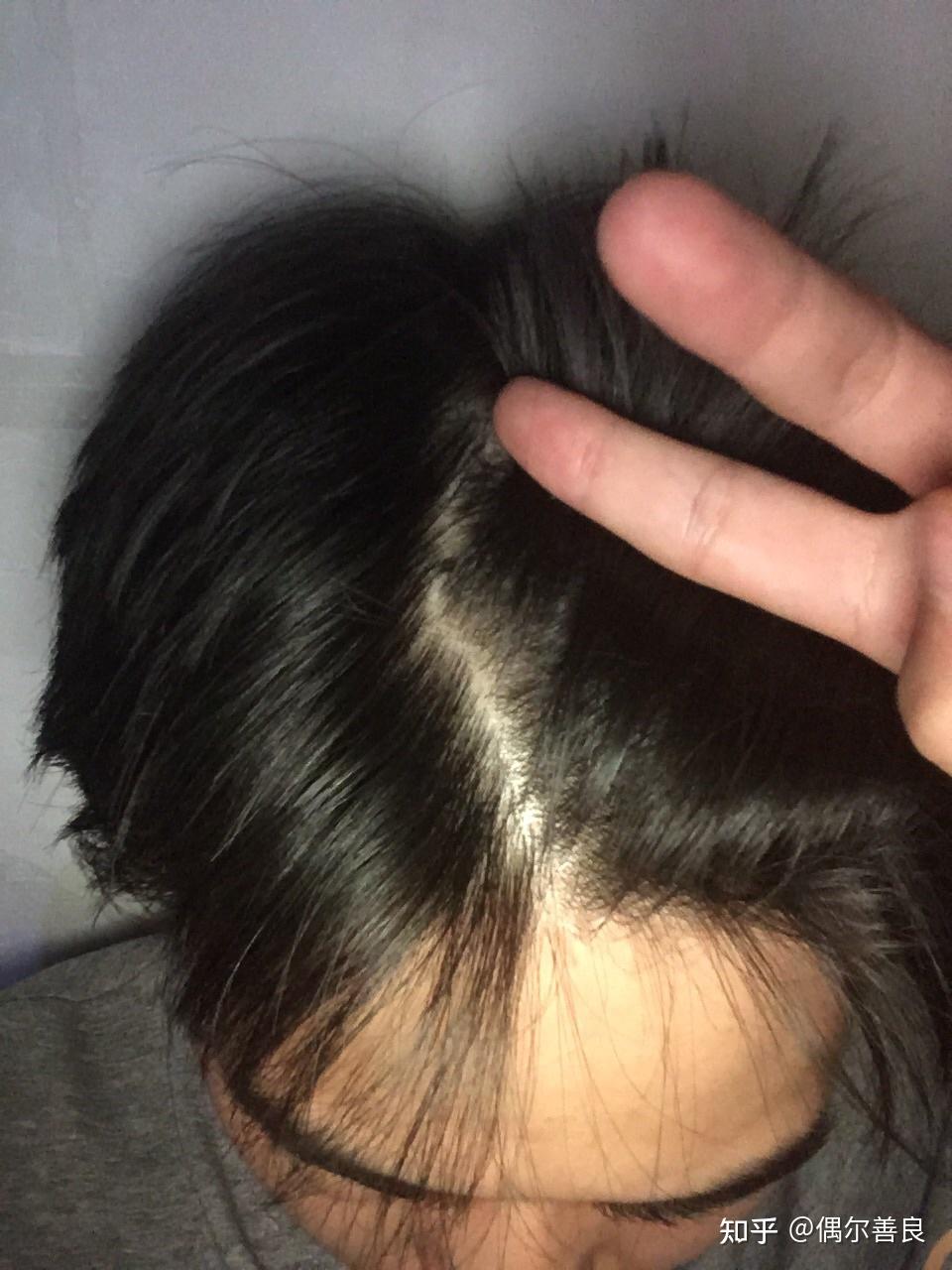 各位大神帮我看看这头发密度正常吗? - 知乎