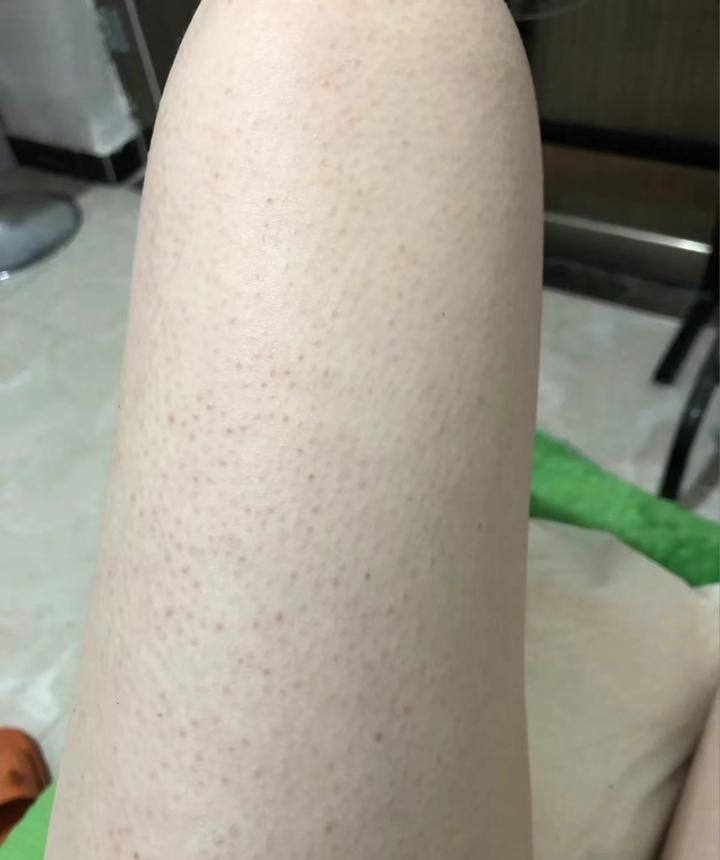 鸡皮多到自卑,一直想找东西去鸡皮的,有没有可靠有效的产品推荐啊? - 知乎