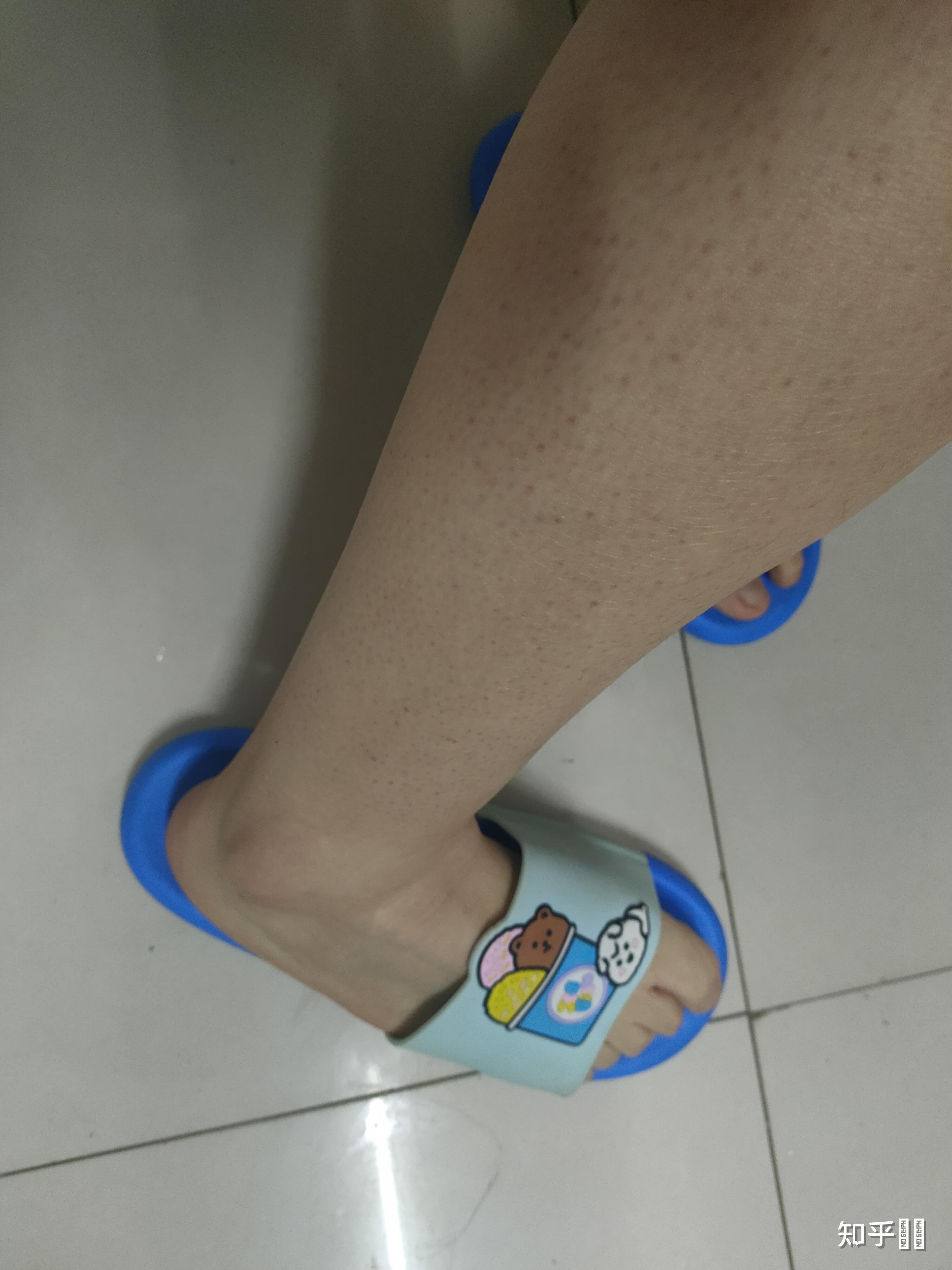腿鸡皮肤色素推荐(腿鸡皮肤色素推荐什么)