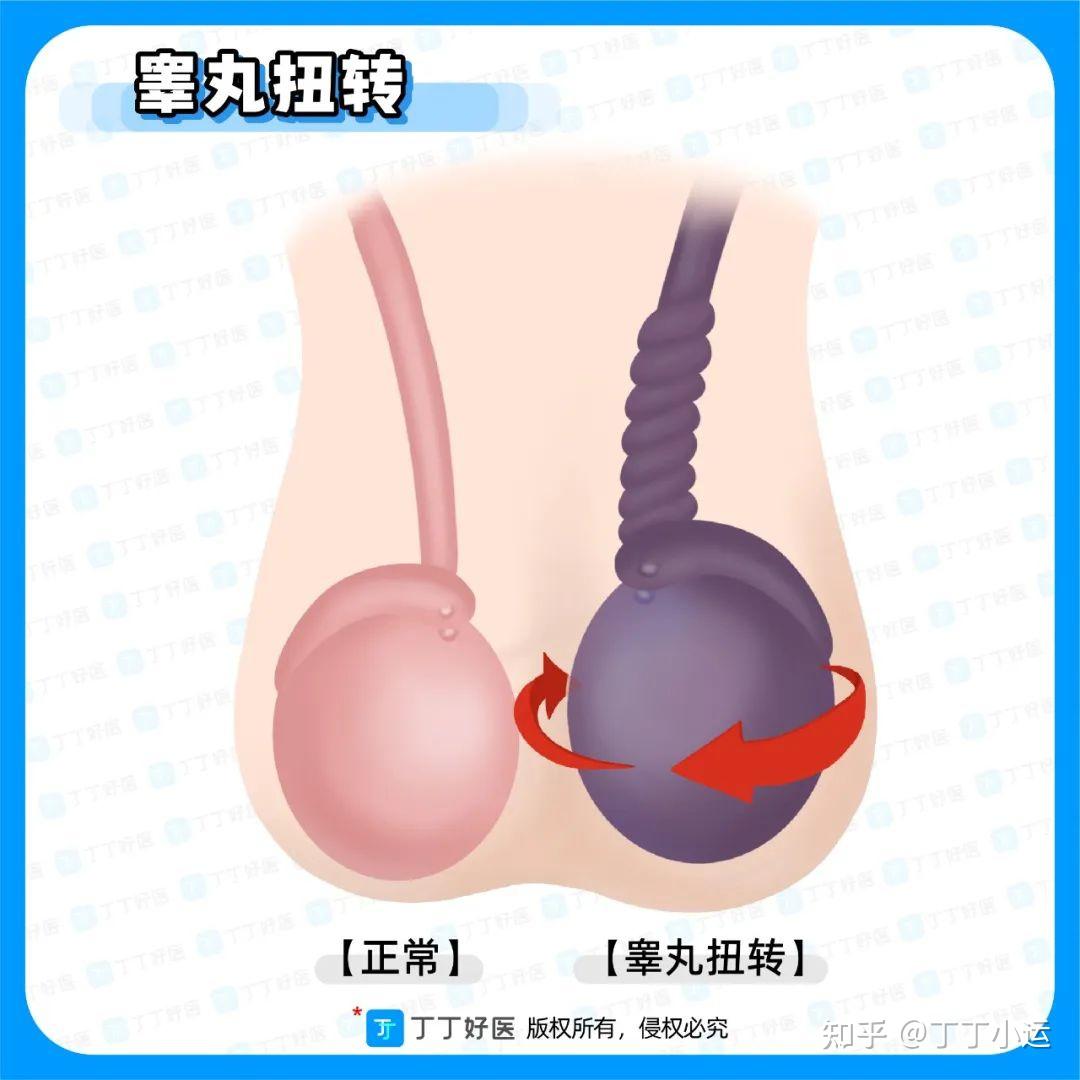 伴有酸胀感觉,低热症状,明显左侧睾丸抬高了,但是彩超显示血流正常,但