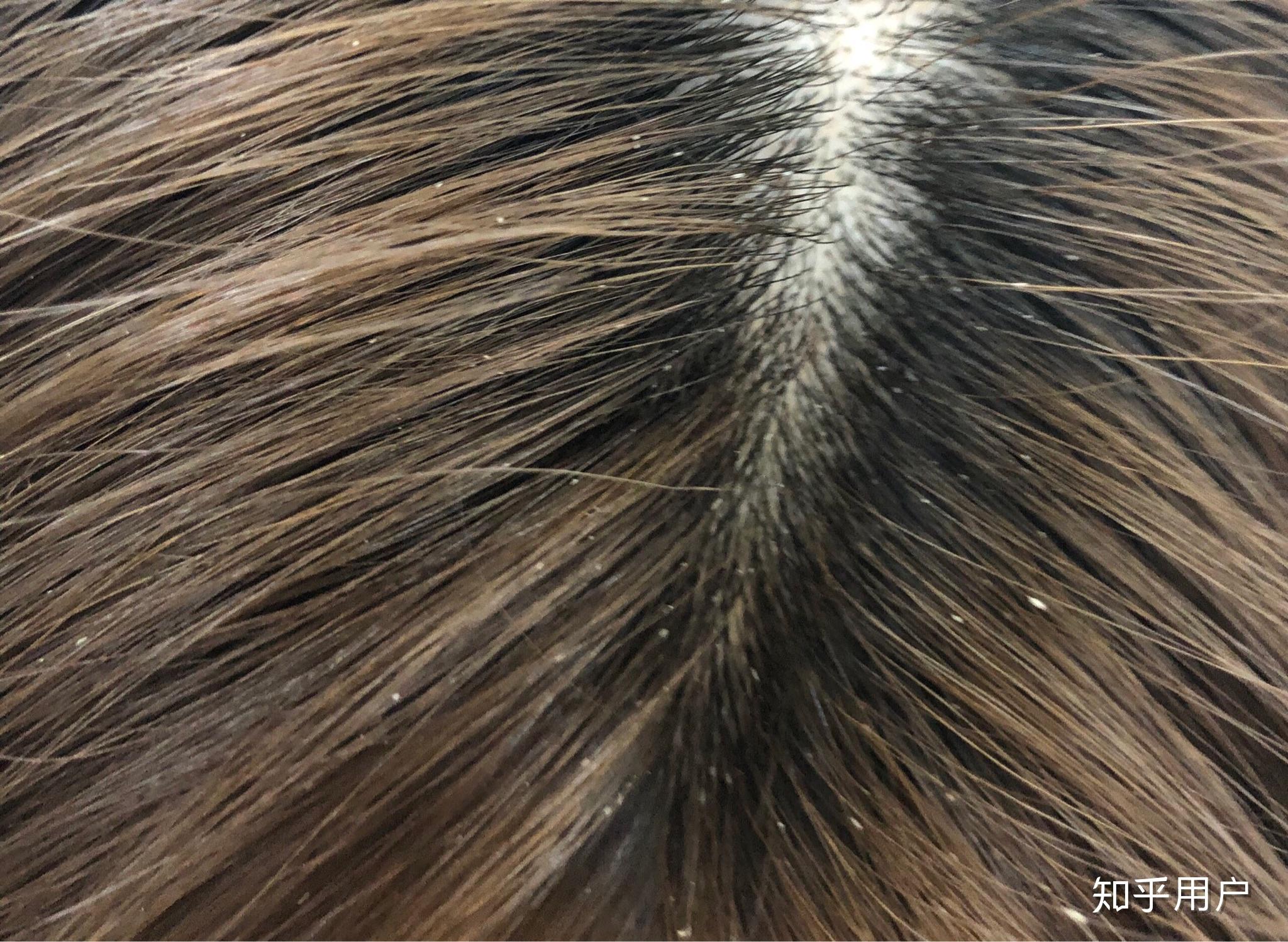 有什么办法可以去"卷发虫"? - 知乎