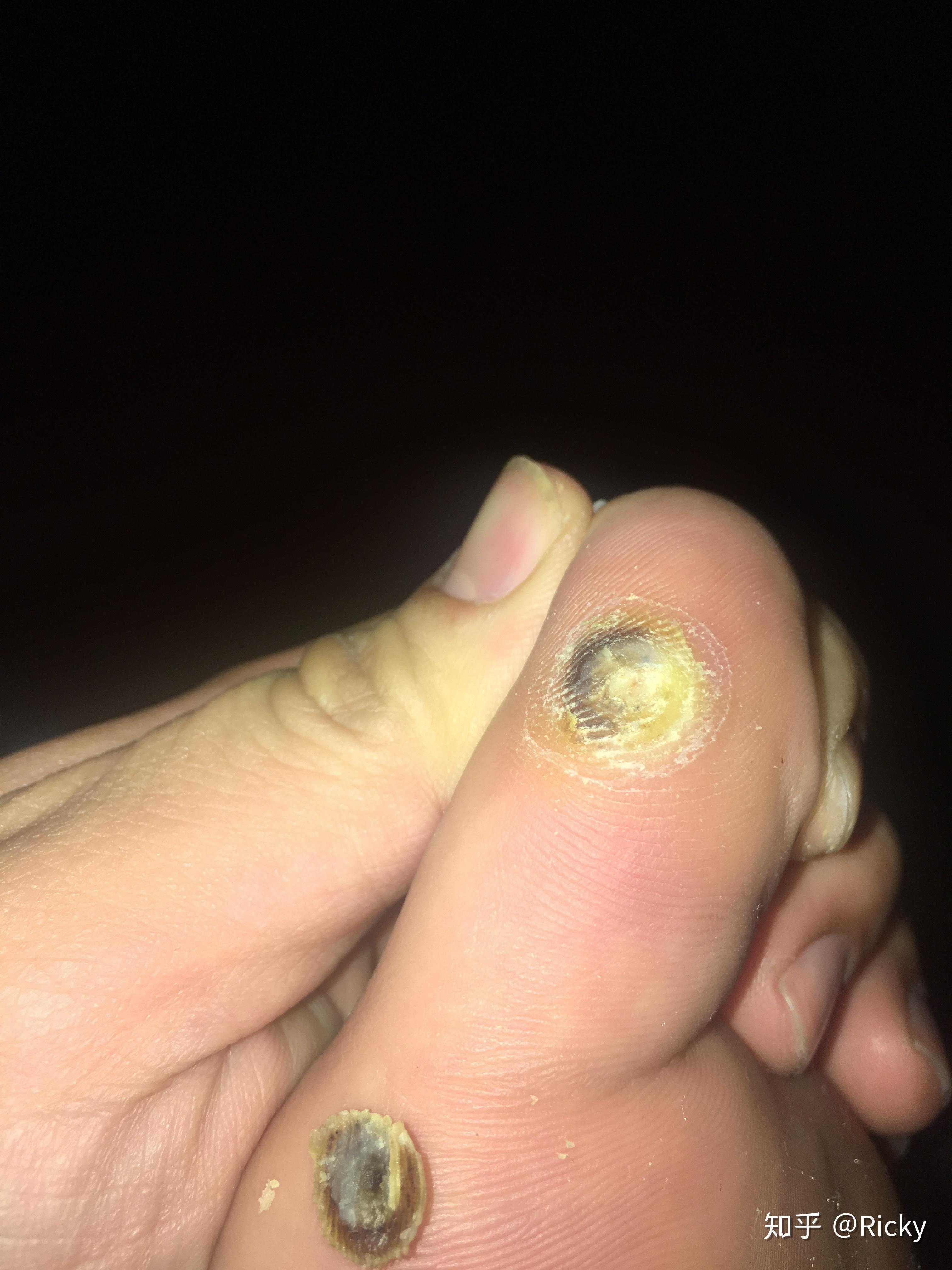 刚长出来的小跖疣怎么治?