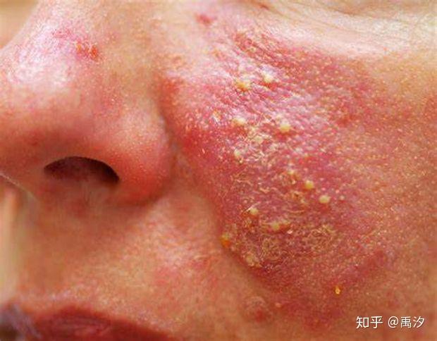 请问头部脂溢性皮炎产生的大块白色片状鳞片到底是什么