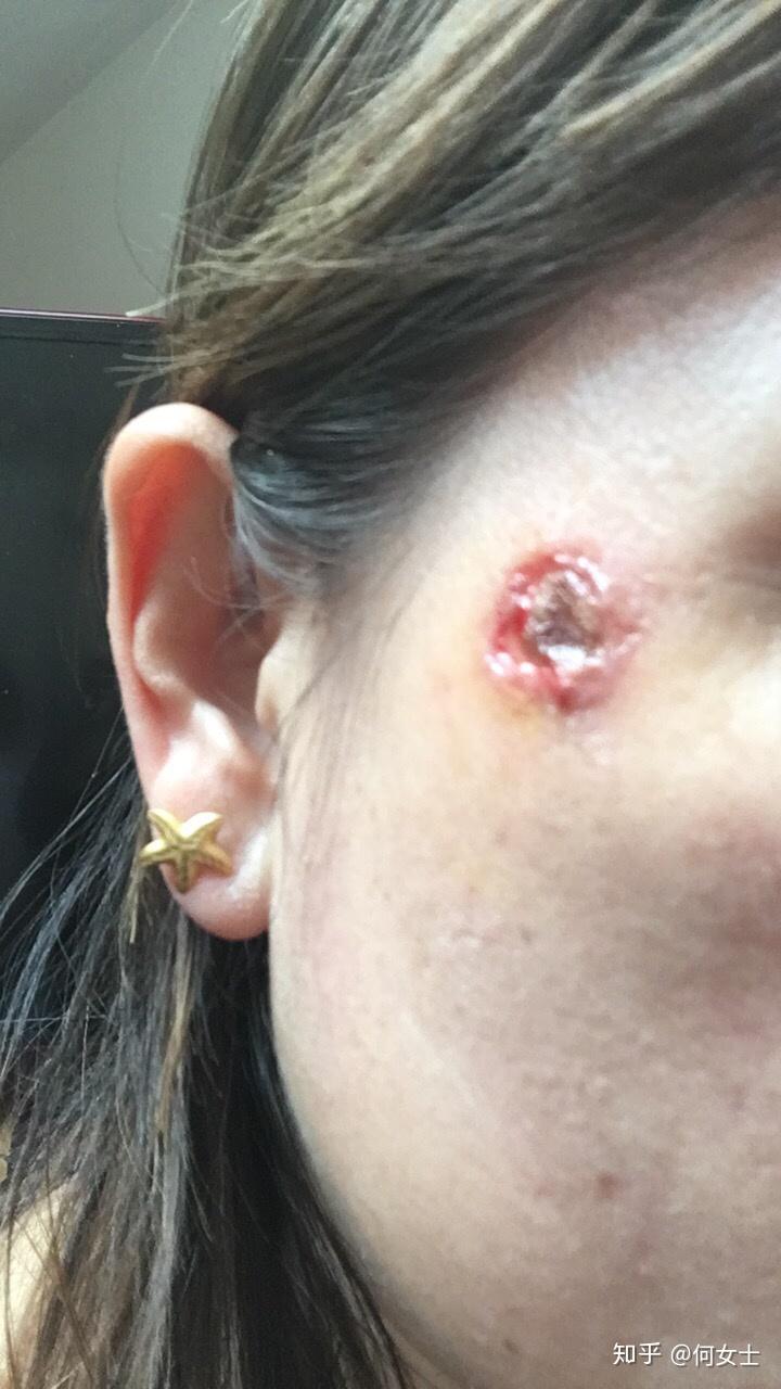 为什么点完痣用了两天消毒液后用修复液,一涂修复液就流脓? - 知乎