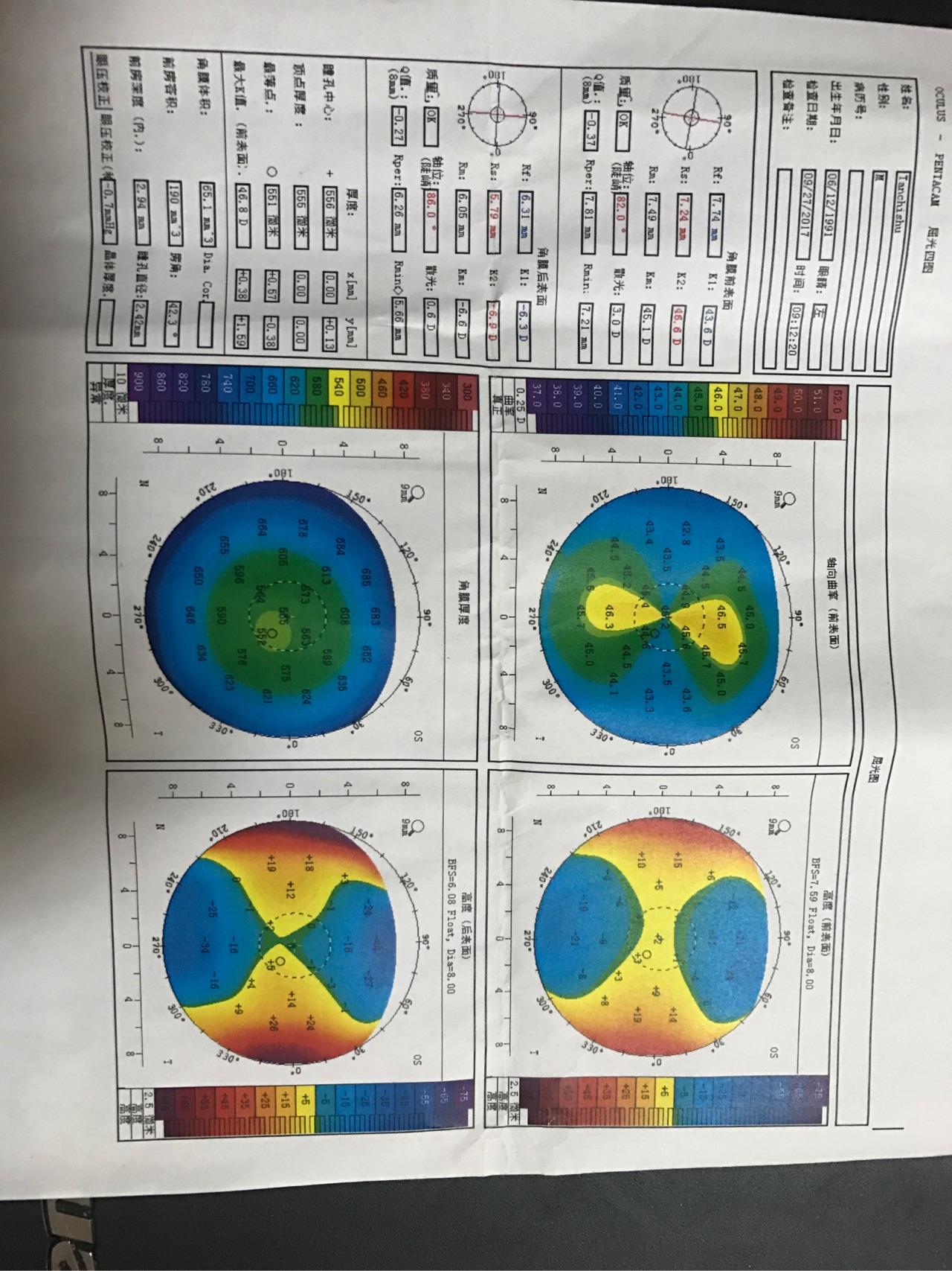 请大神看一下角膜地形图是不是不规则散光晚上看东西上下重影
