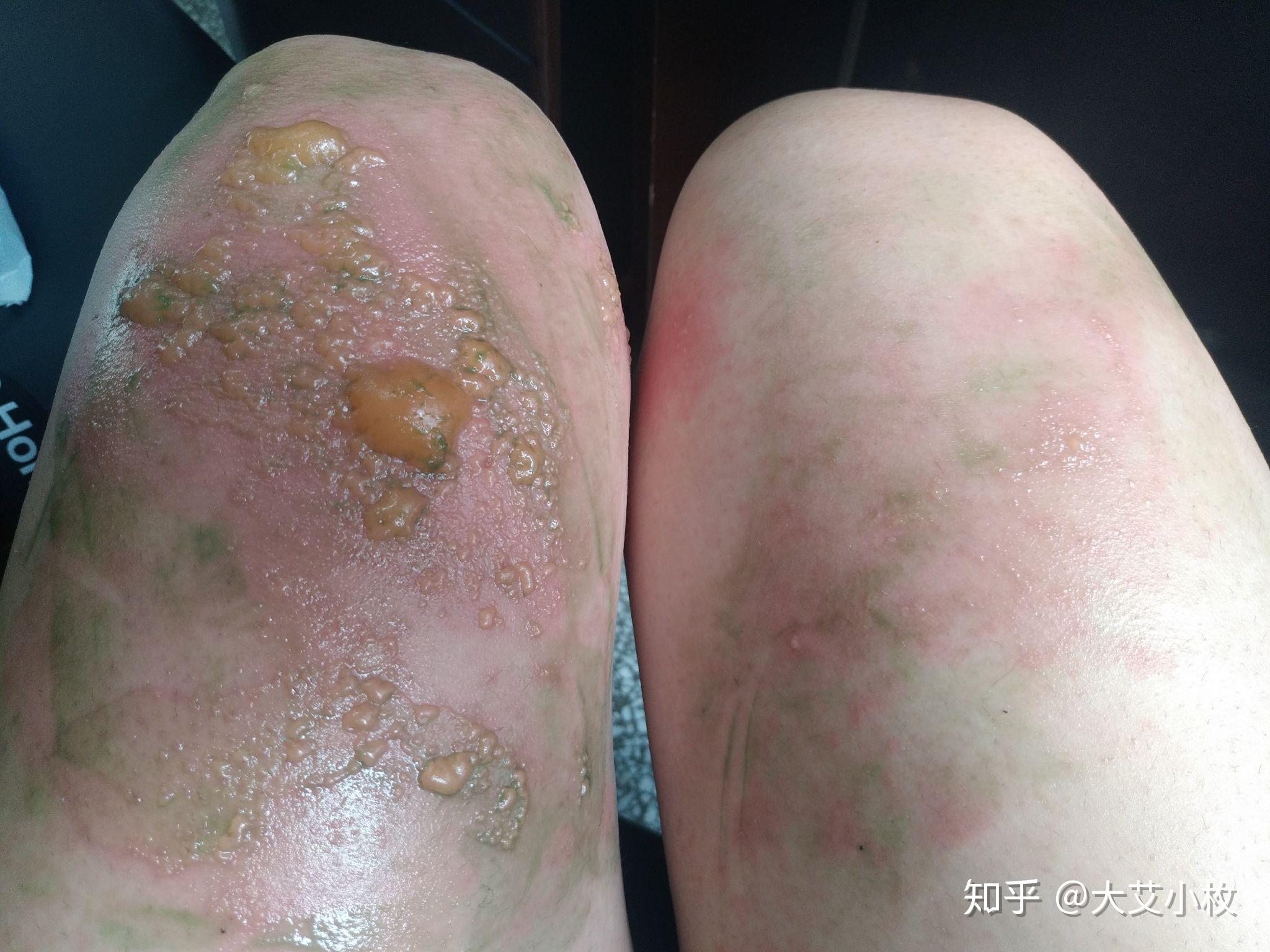 对紫外线过敏是一种怎样的体验? - 知乎