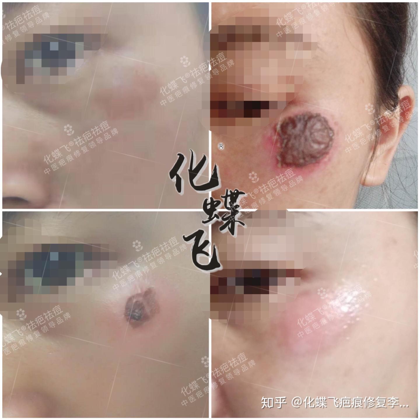 擦伤冻伤留下了色素疤痕怎么办? - 知乎