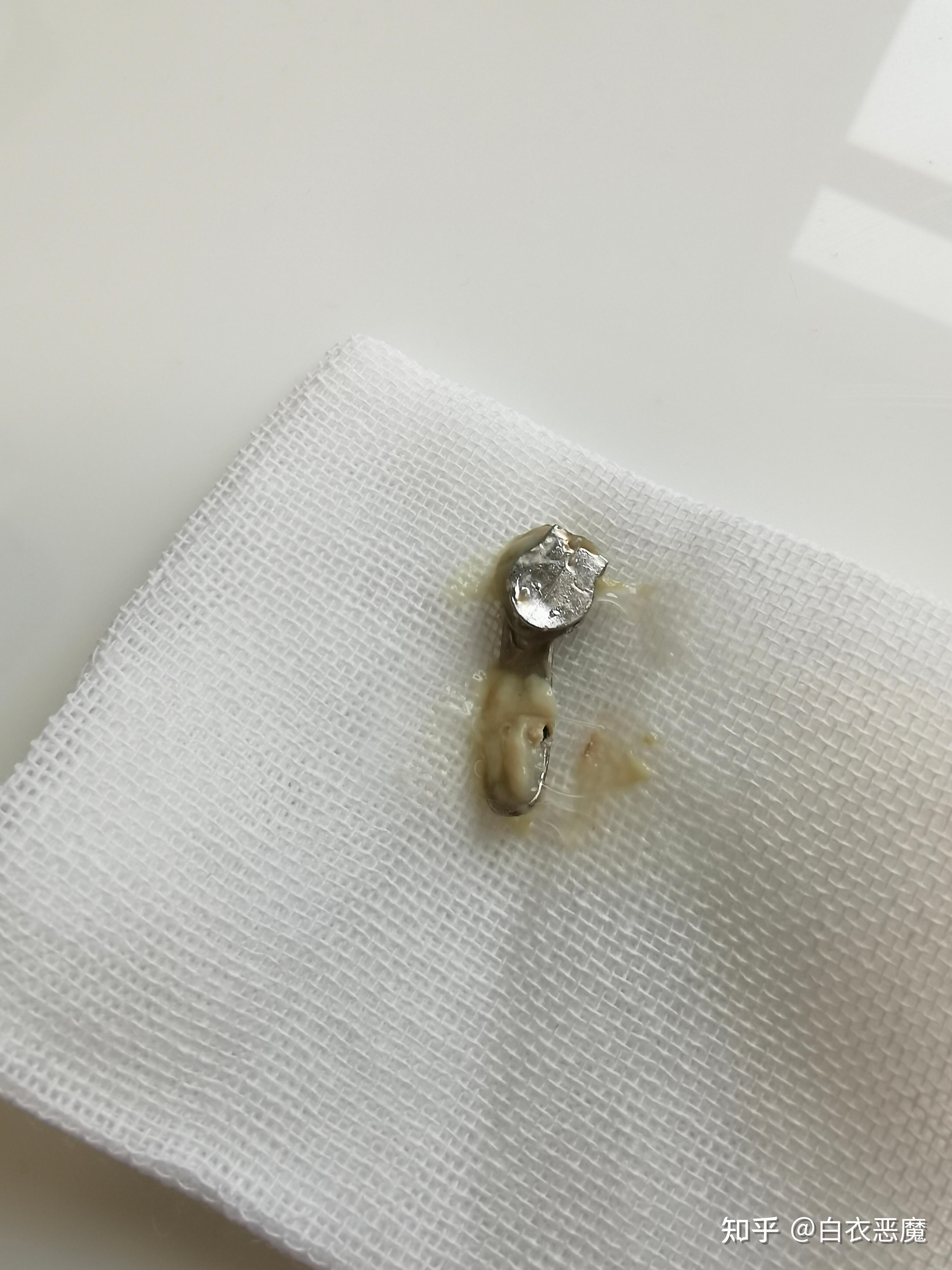 异物进鼻腔会不会有什么危险