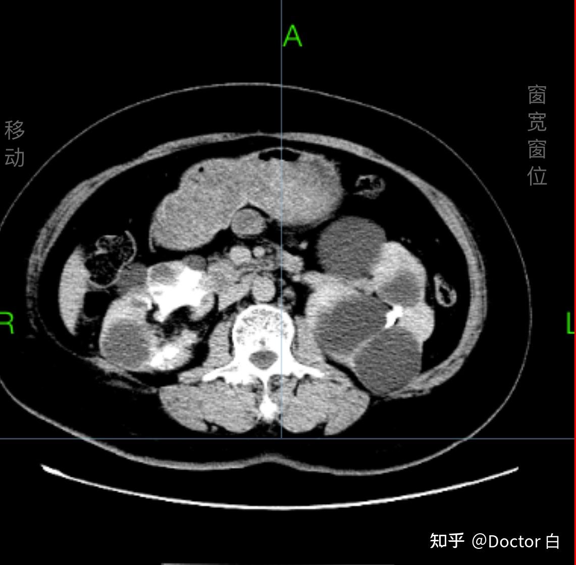 多囊肾图片清晰版图片