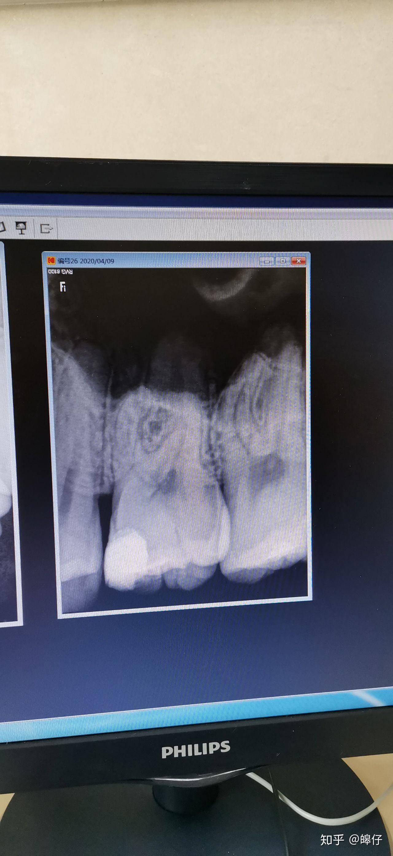 深龋,补牙时没有穿髓,有轻微的自发隐痛. - 知乎