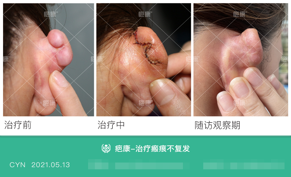 注意穿耳洞養護不當容易造成瘢痕疙瘩