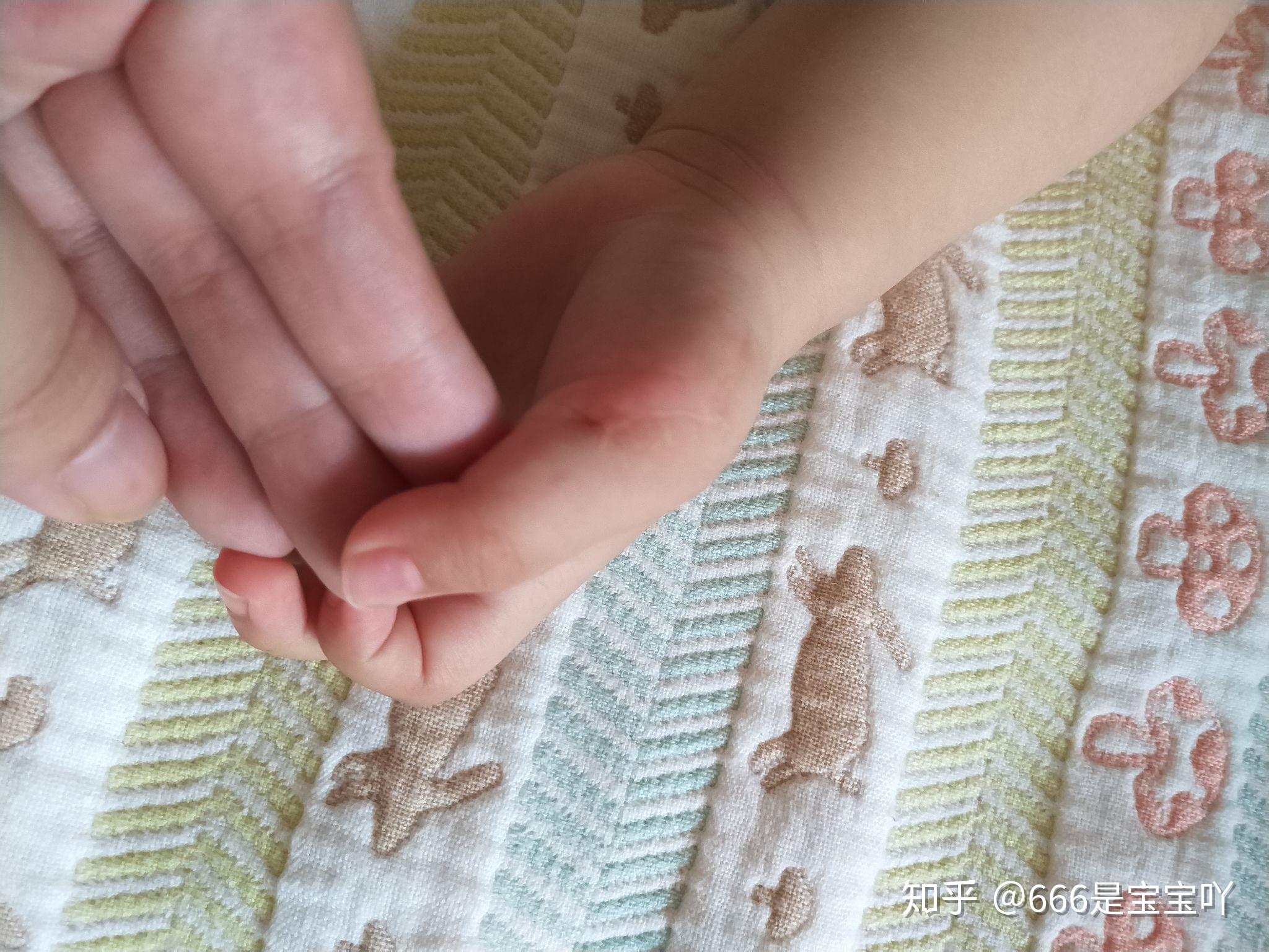 新生儿六指多大月龄做手术合适术后可以恢复到完全没有异常吗