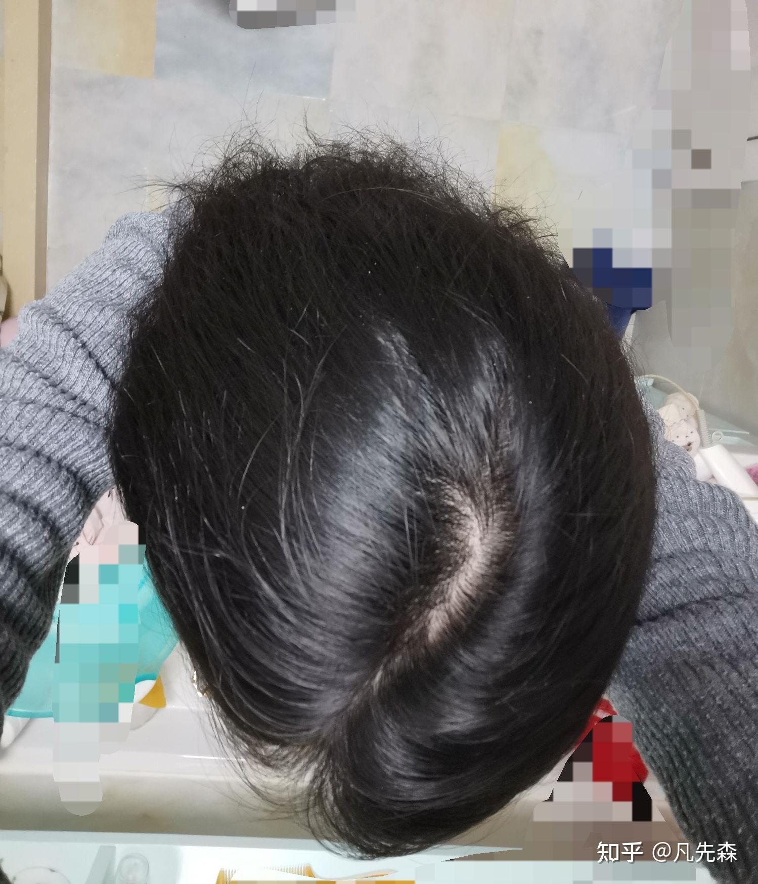 这样的发缝算正常吗? - 知乎