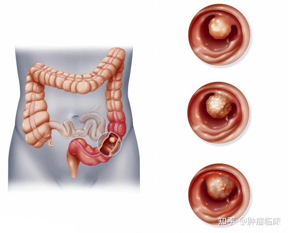 早期直肠肿瘤的症状图片