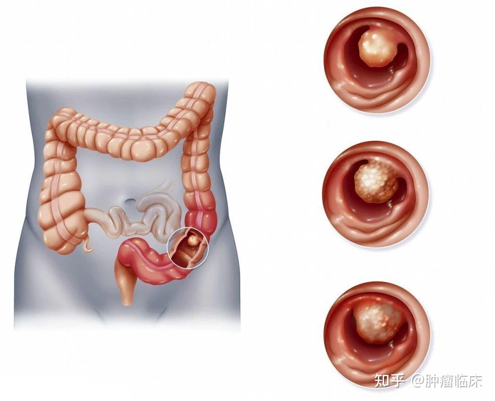 直肠癌有哪些常见症状? - 知乎