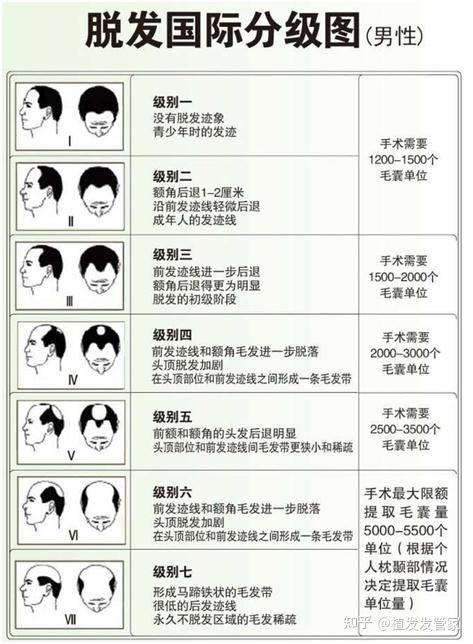 额角秃了怎么办?进行额角植发需要多少毛囊? - 知乎
