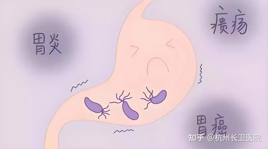 感染幽门螺旋杆菌有必要治疗吗?一键告诉你正确答案~ - 知乎