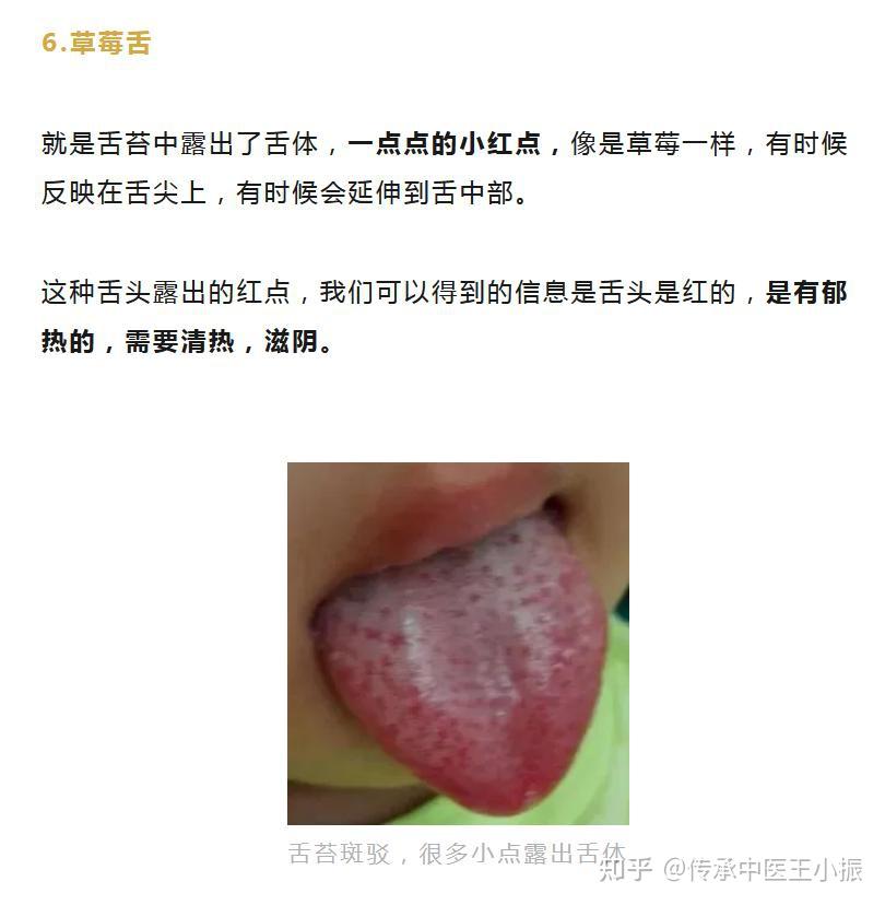 舌象分析:太吓人了,看了10个舌头,没有一个是“好”舌头! - 知乎