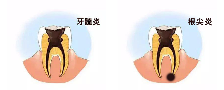 牙髓炎？根尖炎？傻傻分不清楚 - 知乎
