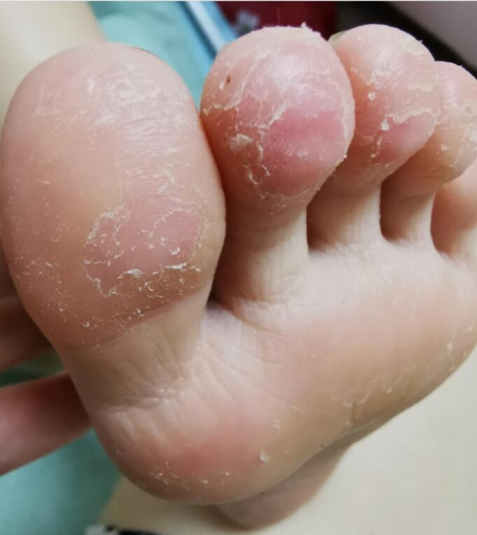 一个简单的外洗方就能轻松治疗脚气比软膏好用