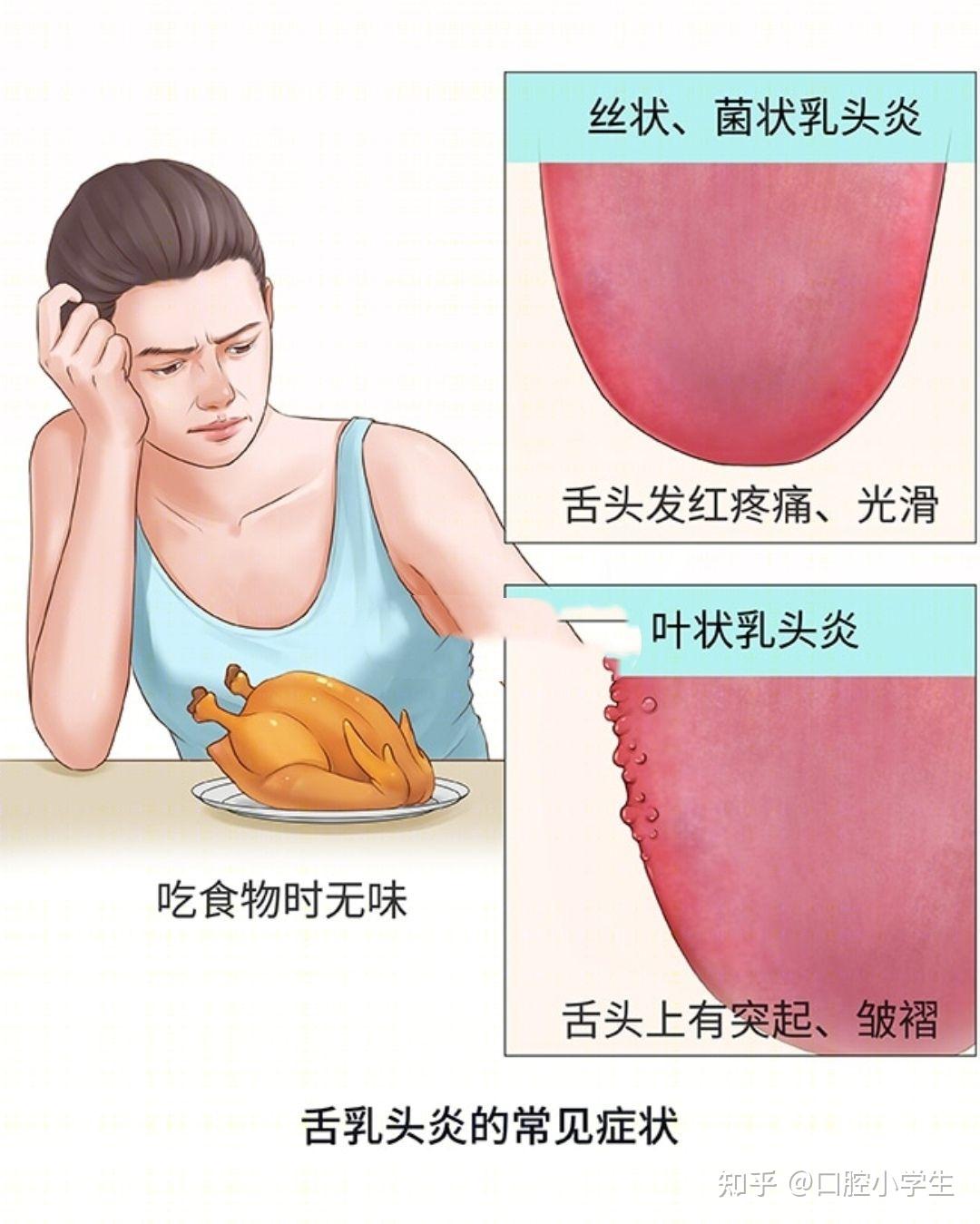舌乳头炎你了解多少？再也不要害怕了！！！ - 知乎