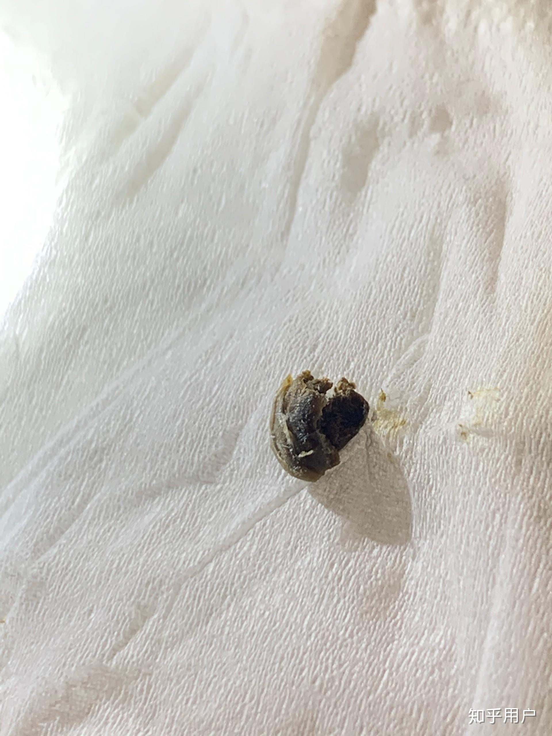 真的有"耳结石"这回事吗? - 知乎