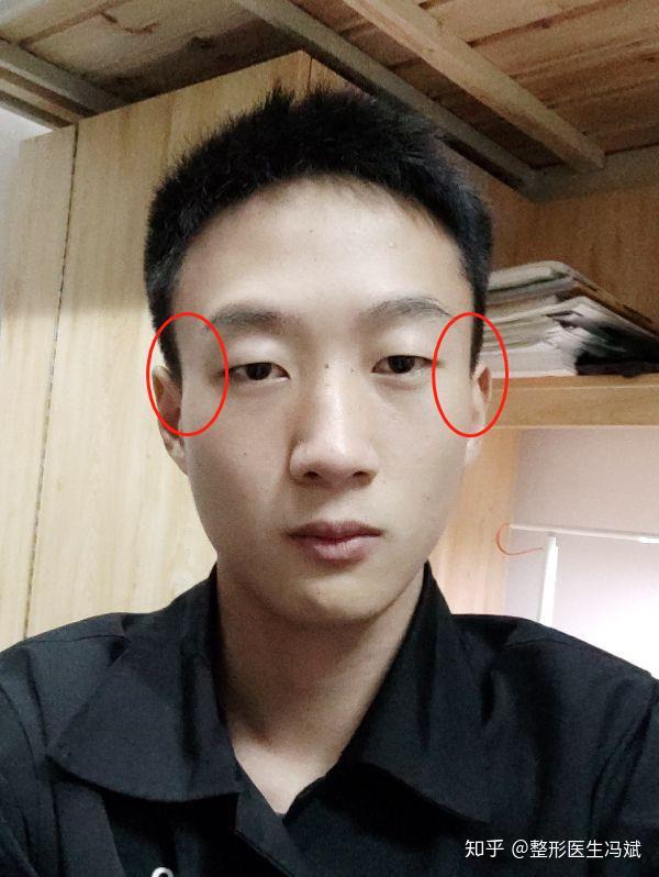 我这是太阳穴凹陷吗