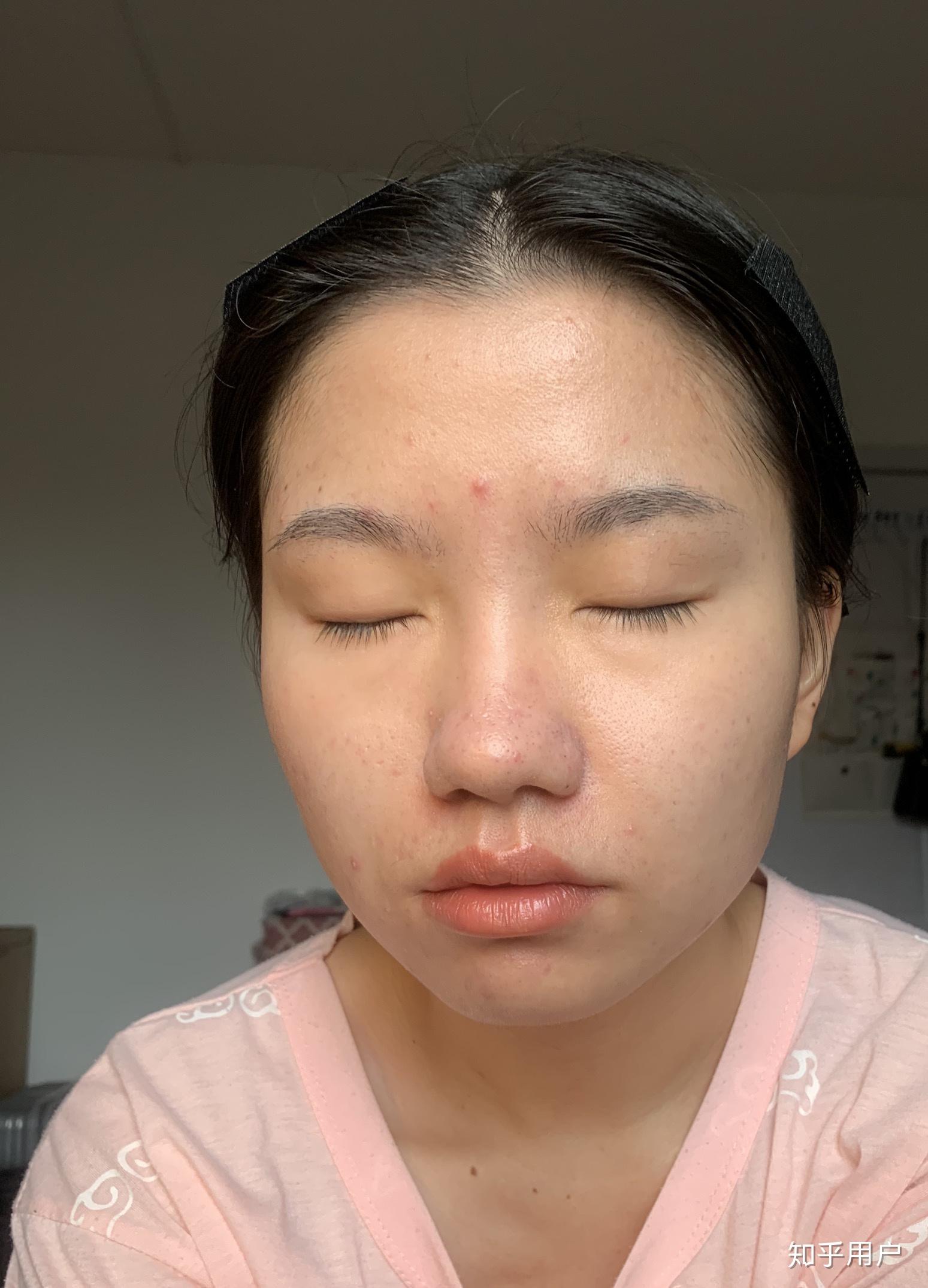 女孩子有酒糟鼻是什么样的体验?